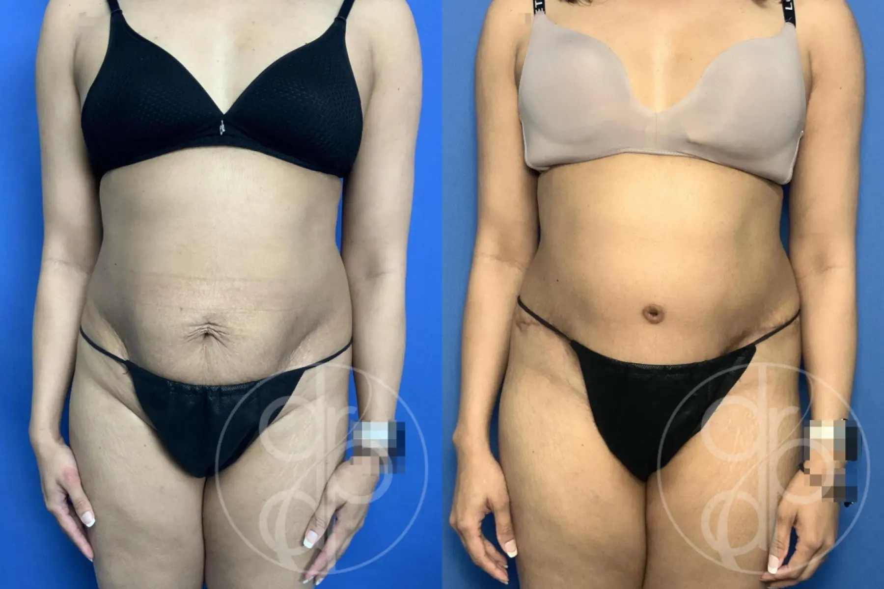 patient 13933 abdominoplasty procedure before and after result - Before and After