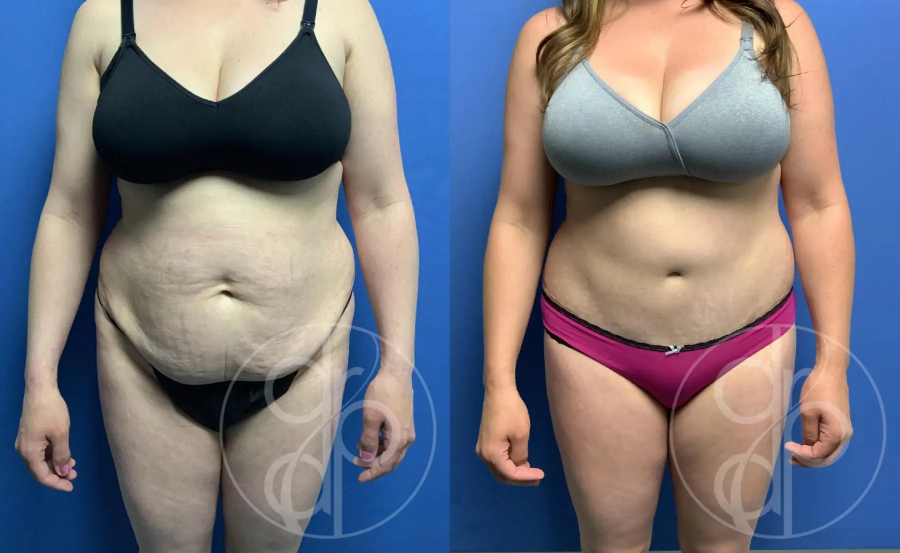 patient 12093 tummy tuck before and after result - Before and After