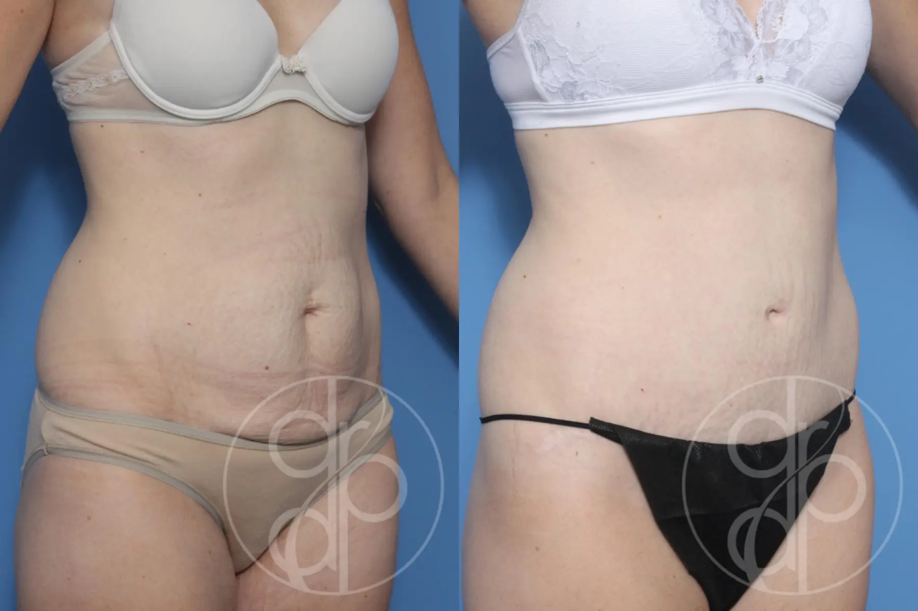 patient 12804 tummy tuck before and after result - Before and After