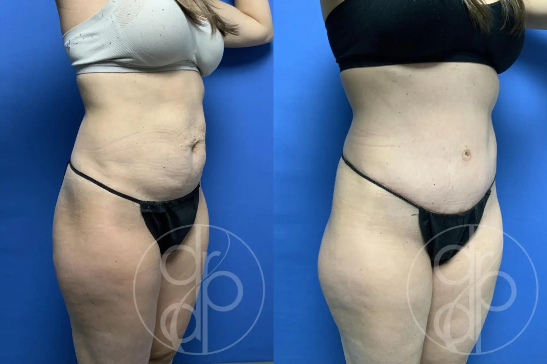 patient 12369 tummy tuck before and after result - Before and After 2