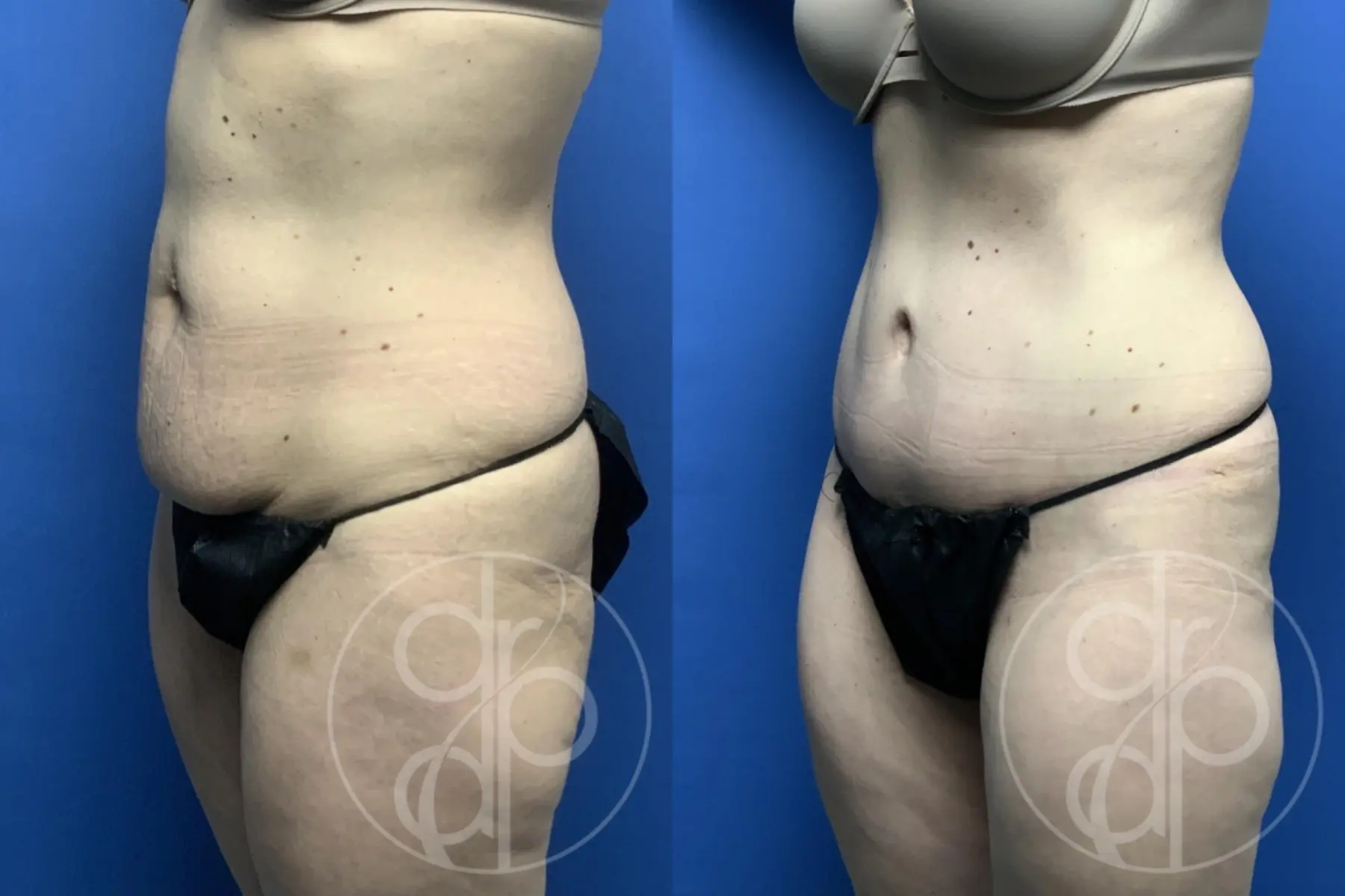 patient 12636 tummy tuck before and after result - Before and After 3