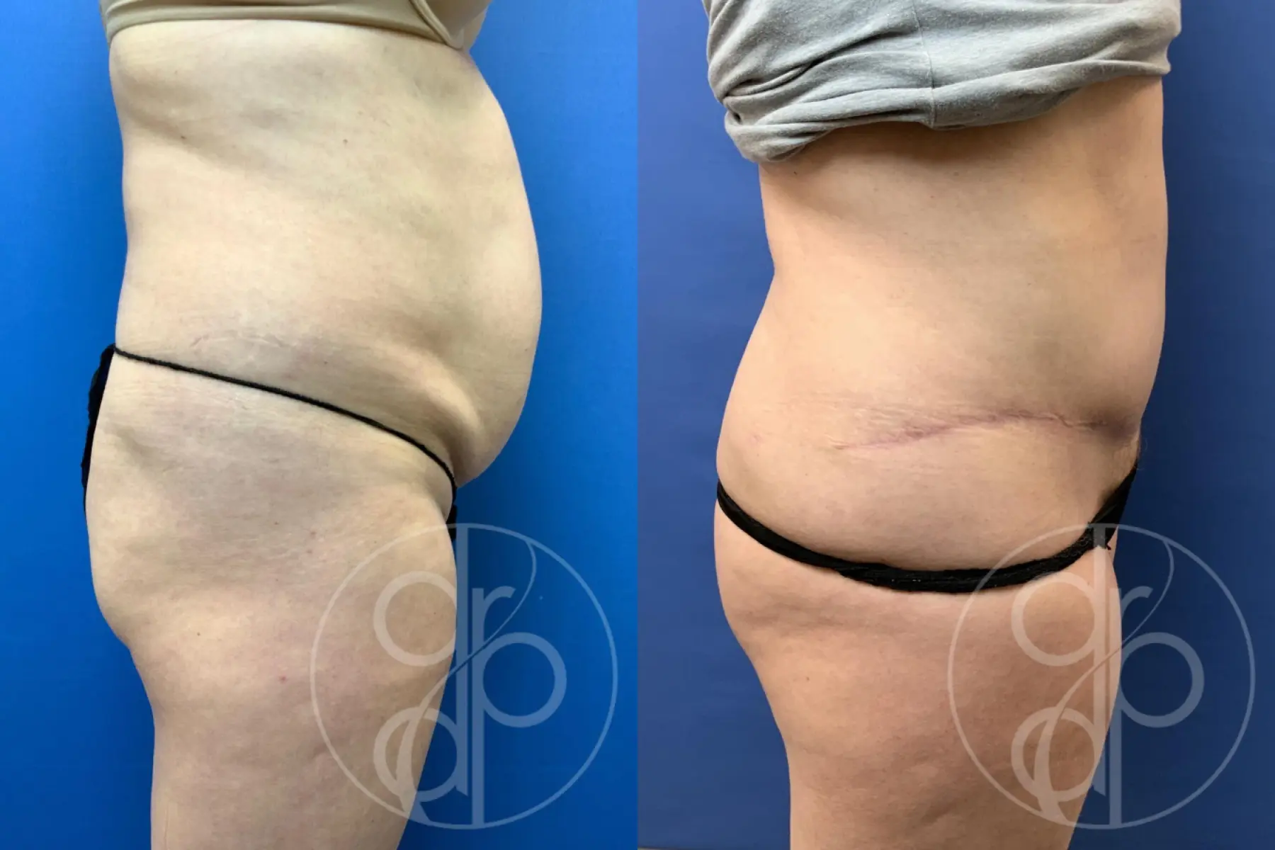 patient 10745 tummy tuck before and after result - Before and After 3