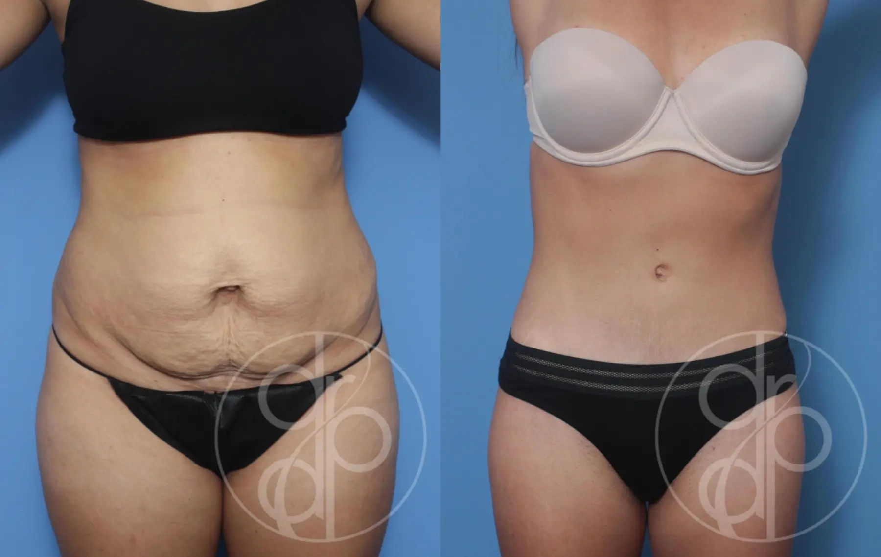 patient 10109 tummy tuck before and after result - Before and After 1