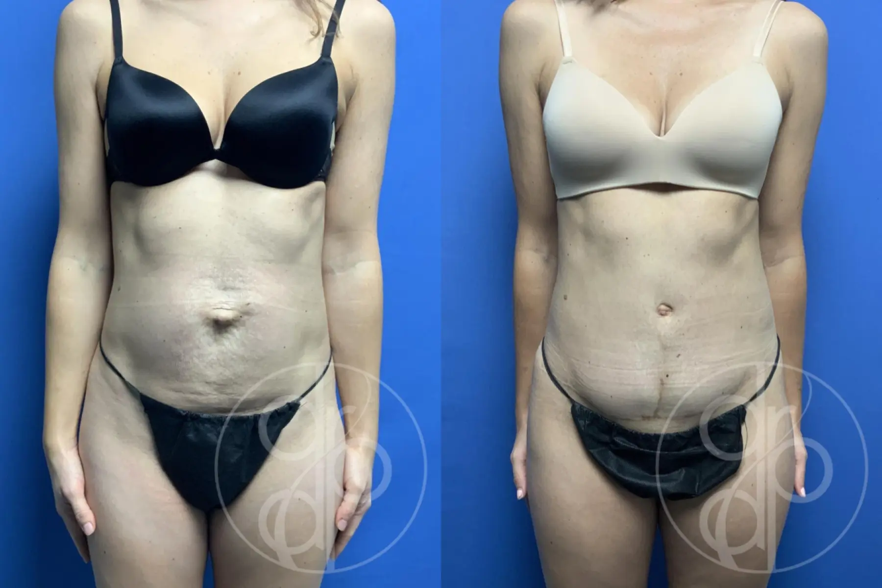 patient 12437 tummy tuck before and after result - Before and After 1