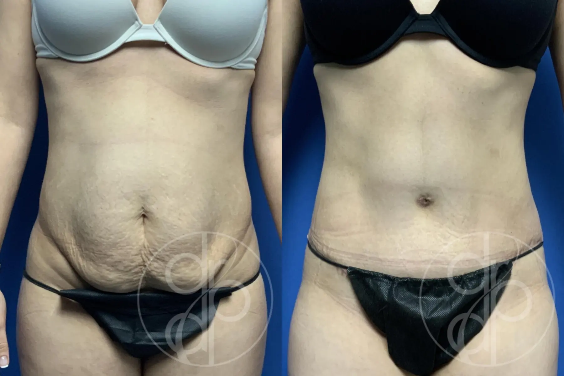 patient 13353 tummy tuck before and after result - Before and After 1