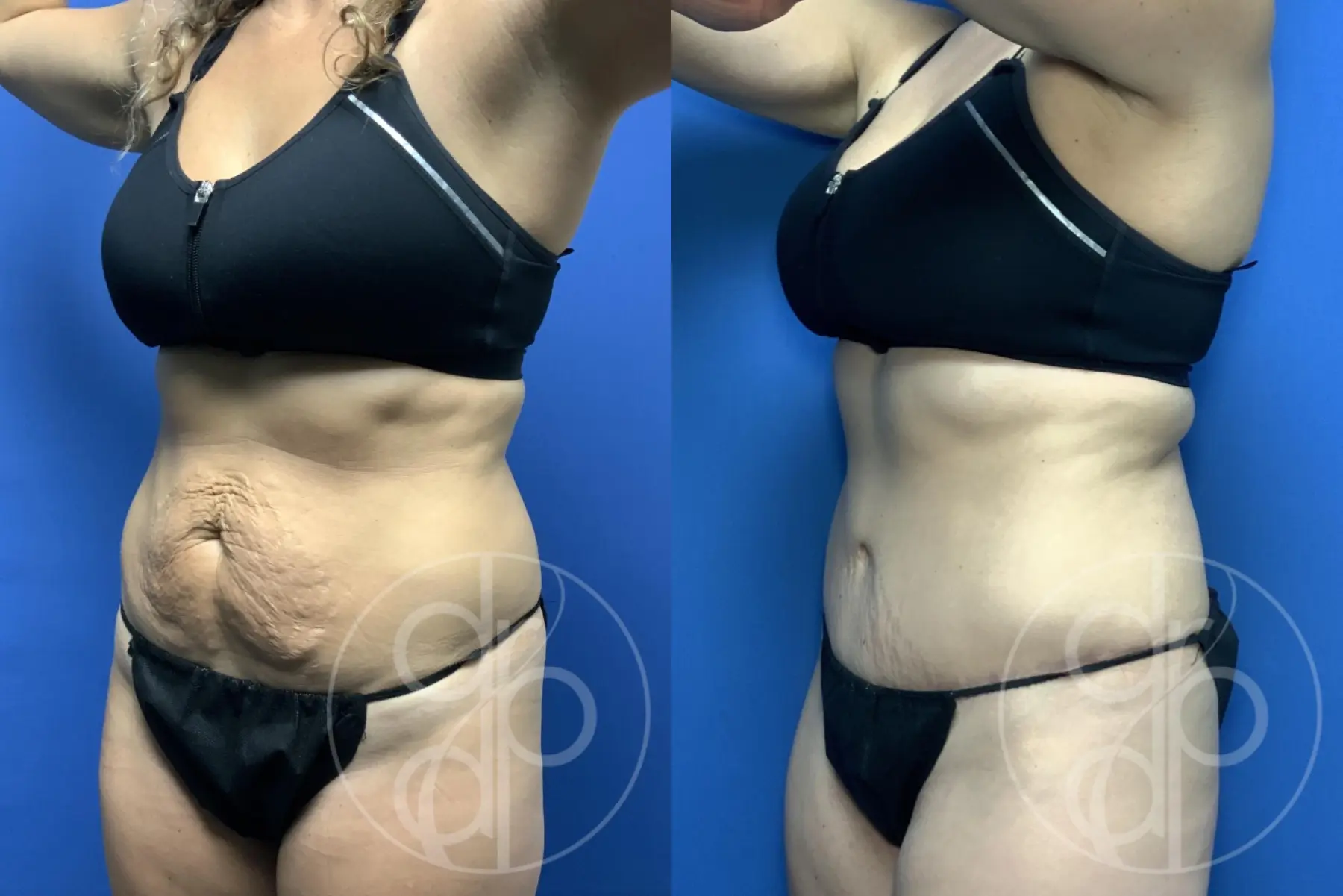 patient 12439 tummy tuck before and after result - Before and After 2