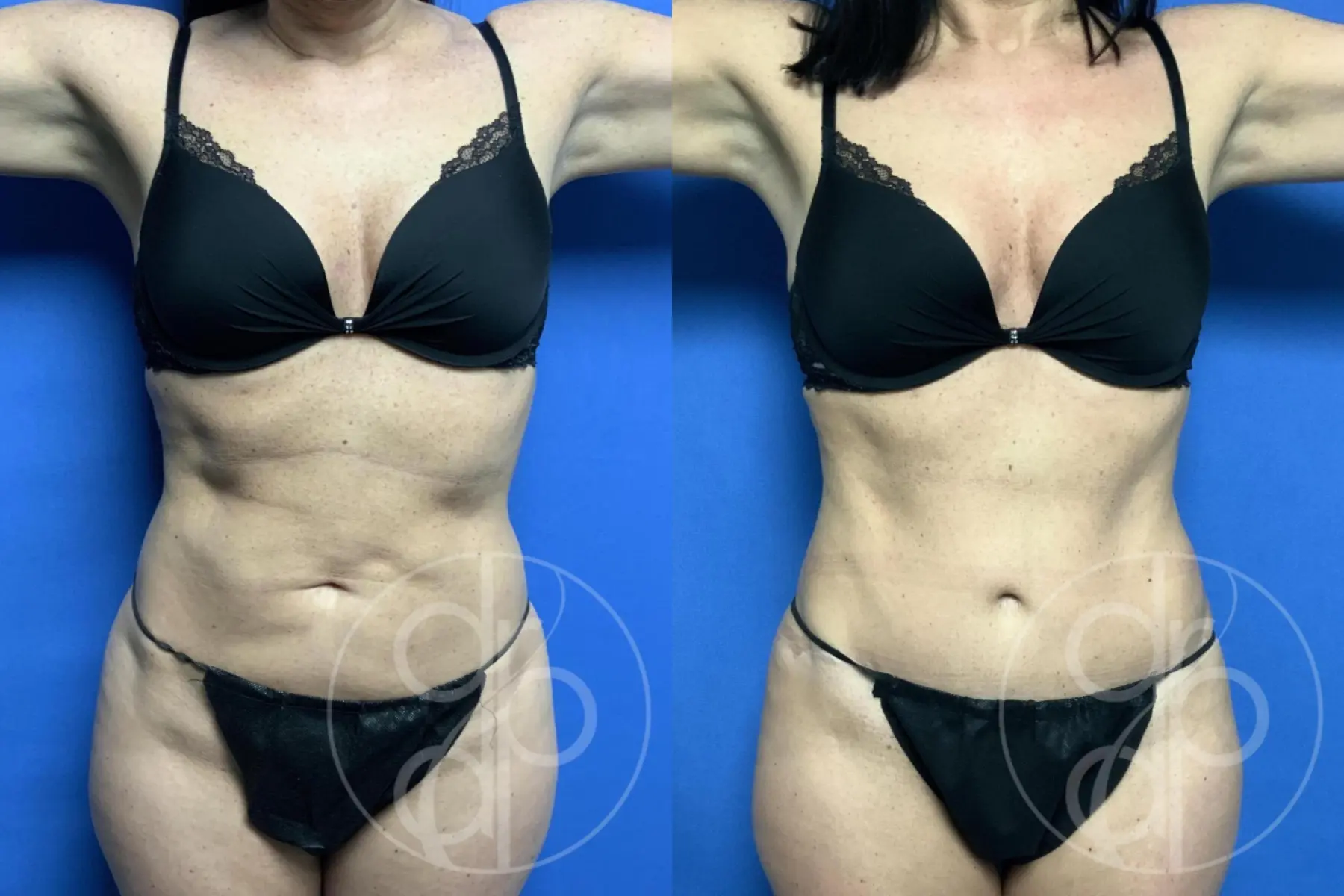 Abdominoplasty: Patient 39 - Before and After 2