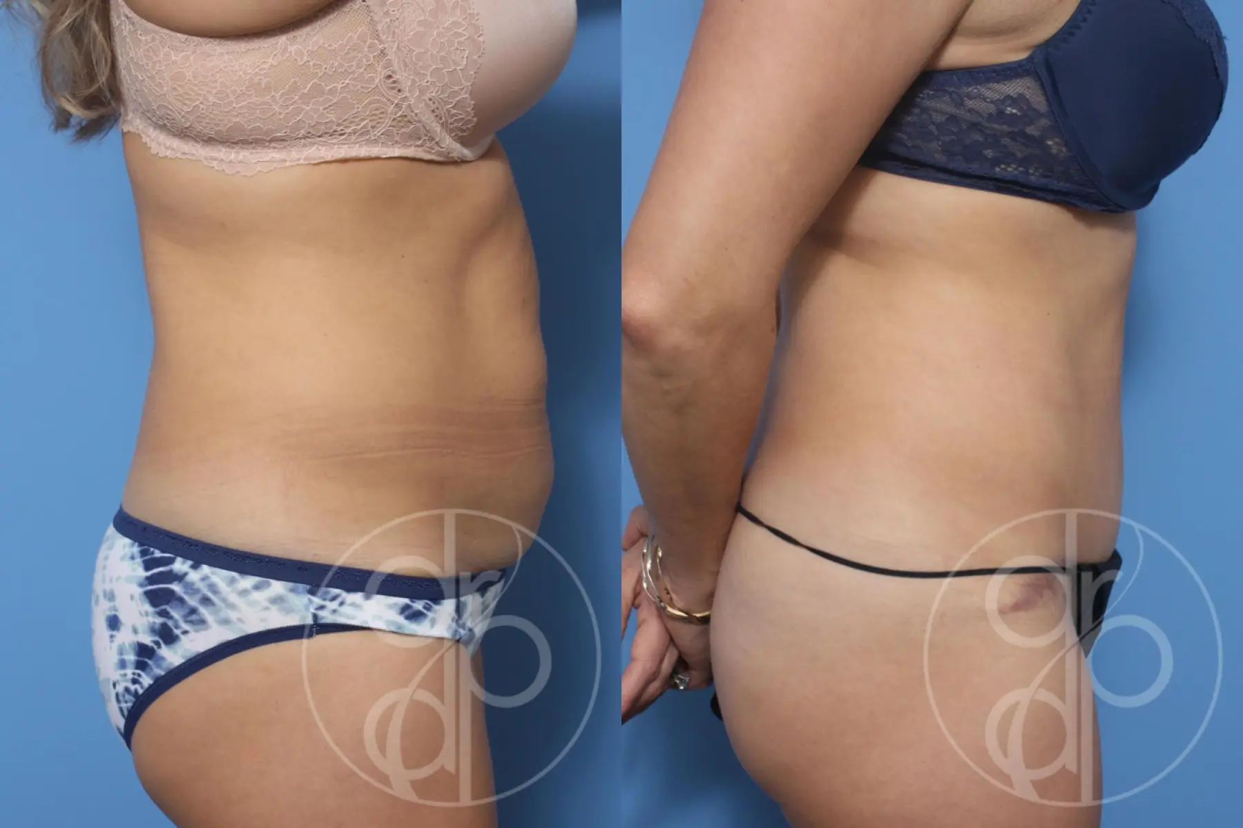patient 13228 tummy tuck before and after result - Before and After 2