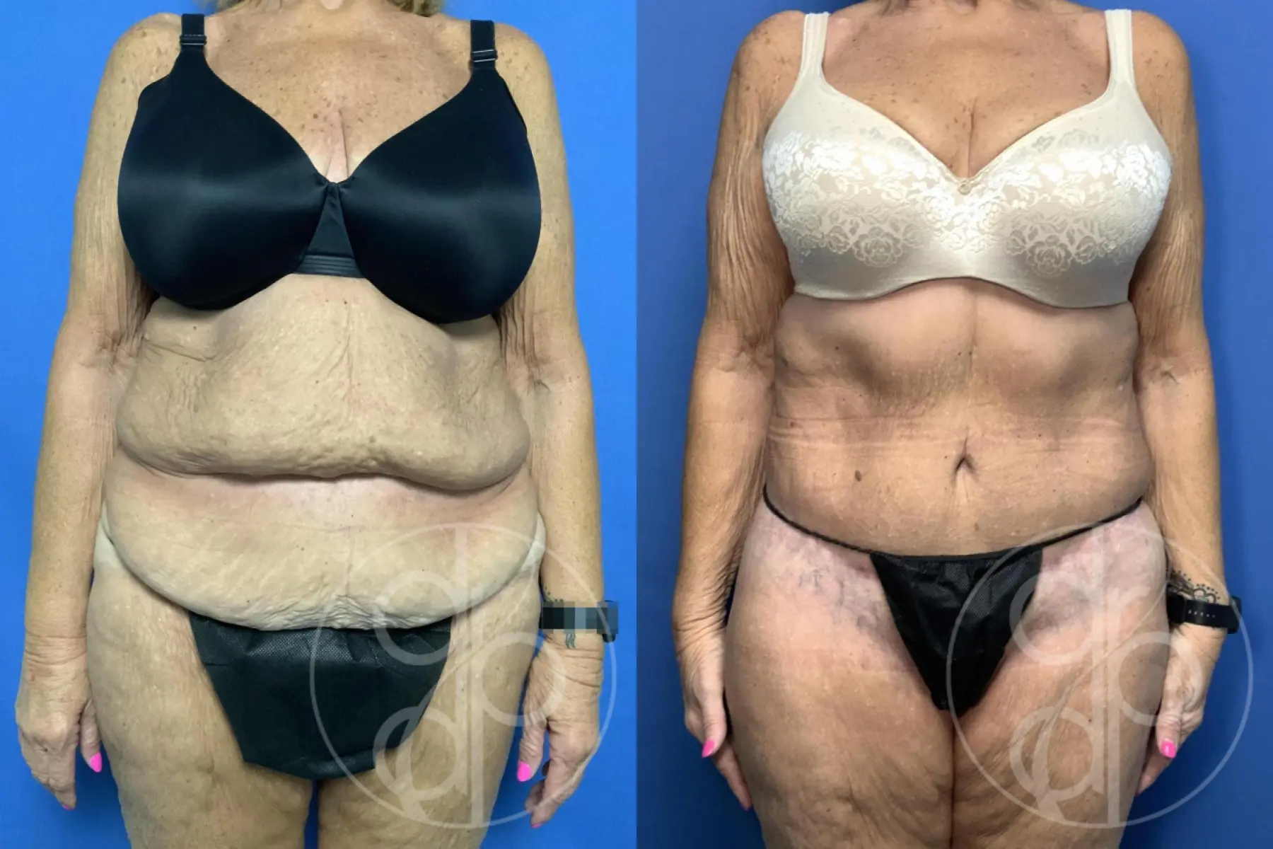 patient 13893 abdominoplasty procedure before and after result - Before and After