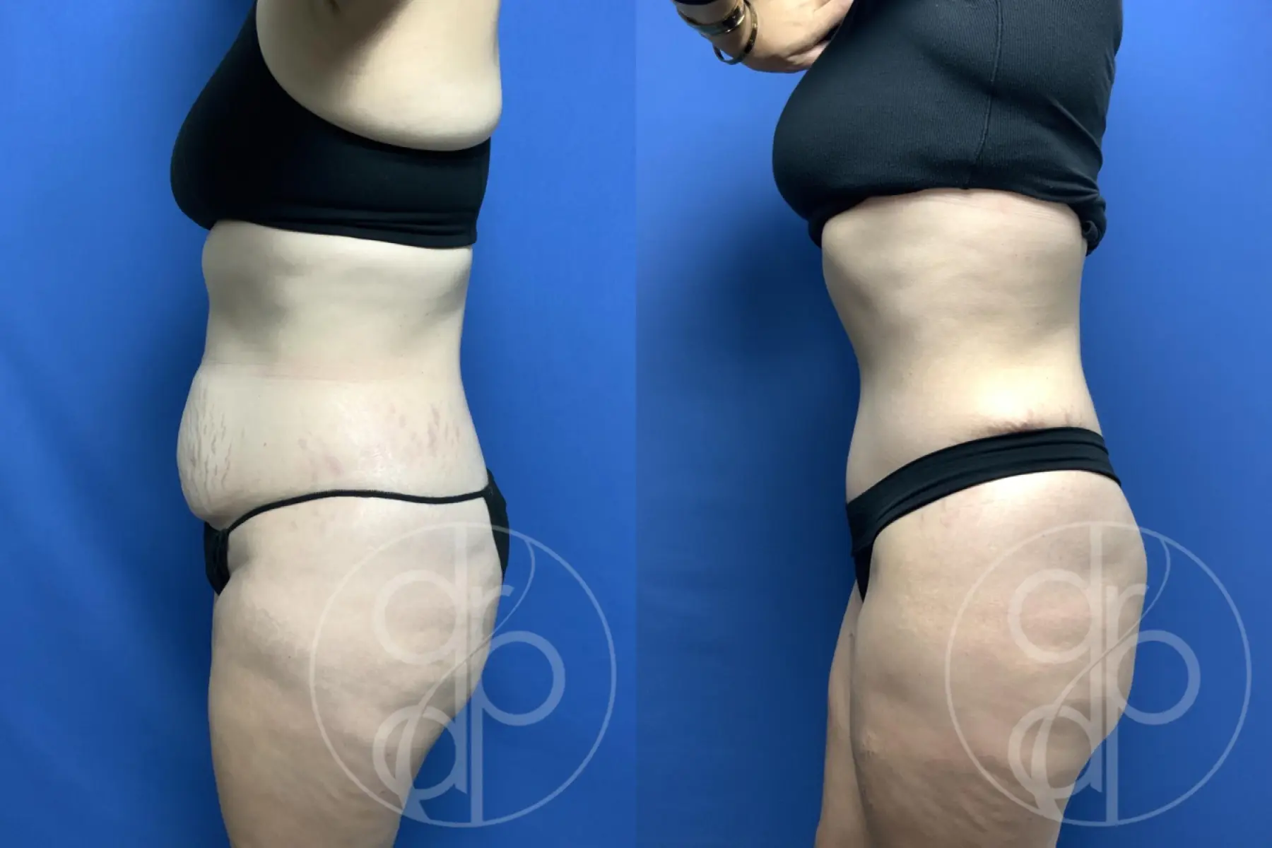patient 12001 tummy tuck before and after result - Before and After 3