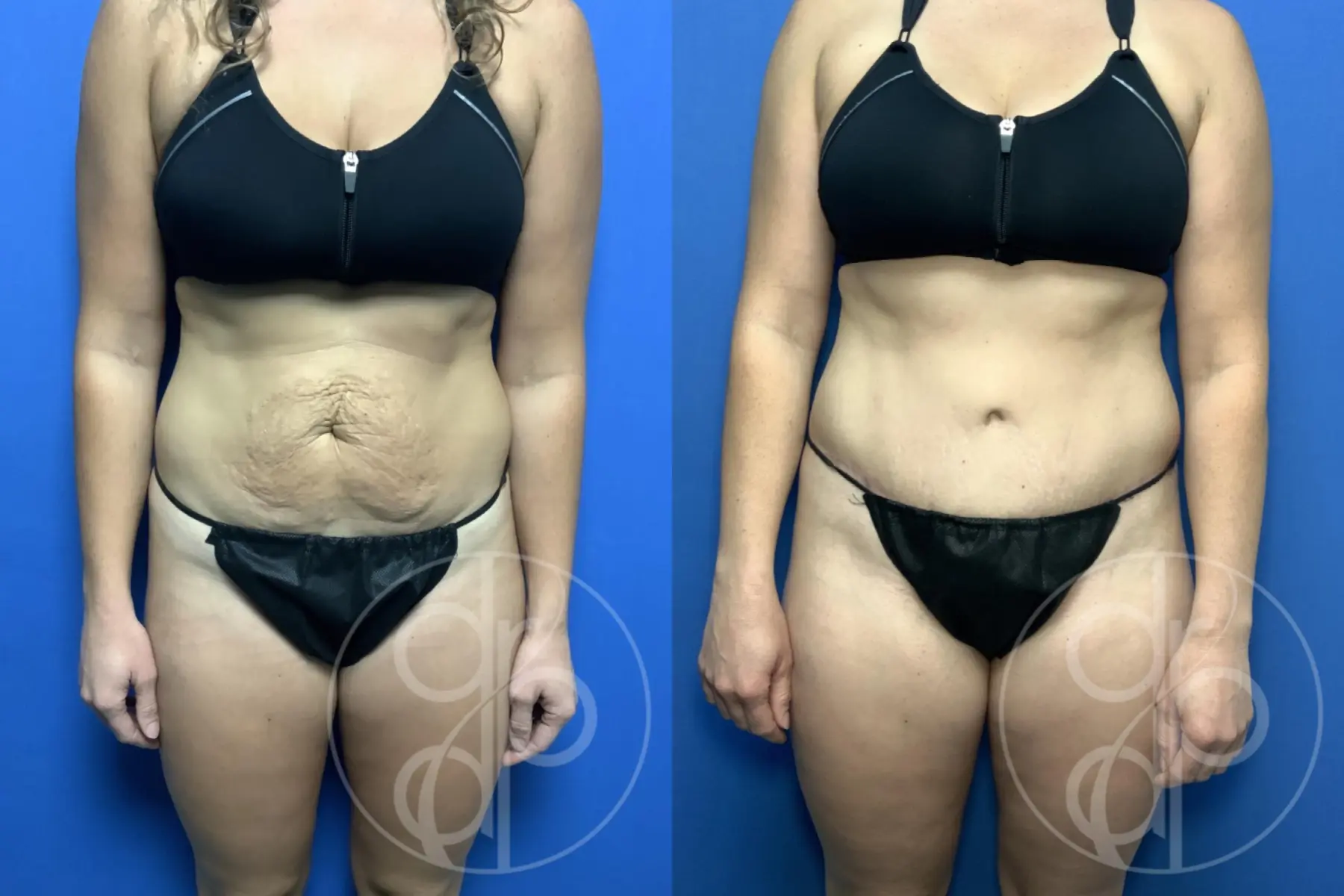 patient 12439 tummy tuck before and after result - Before and After 1