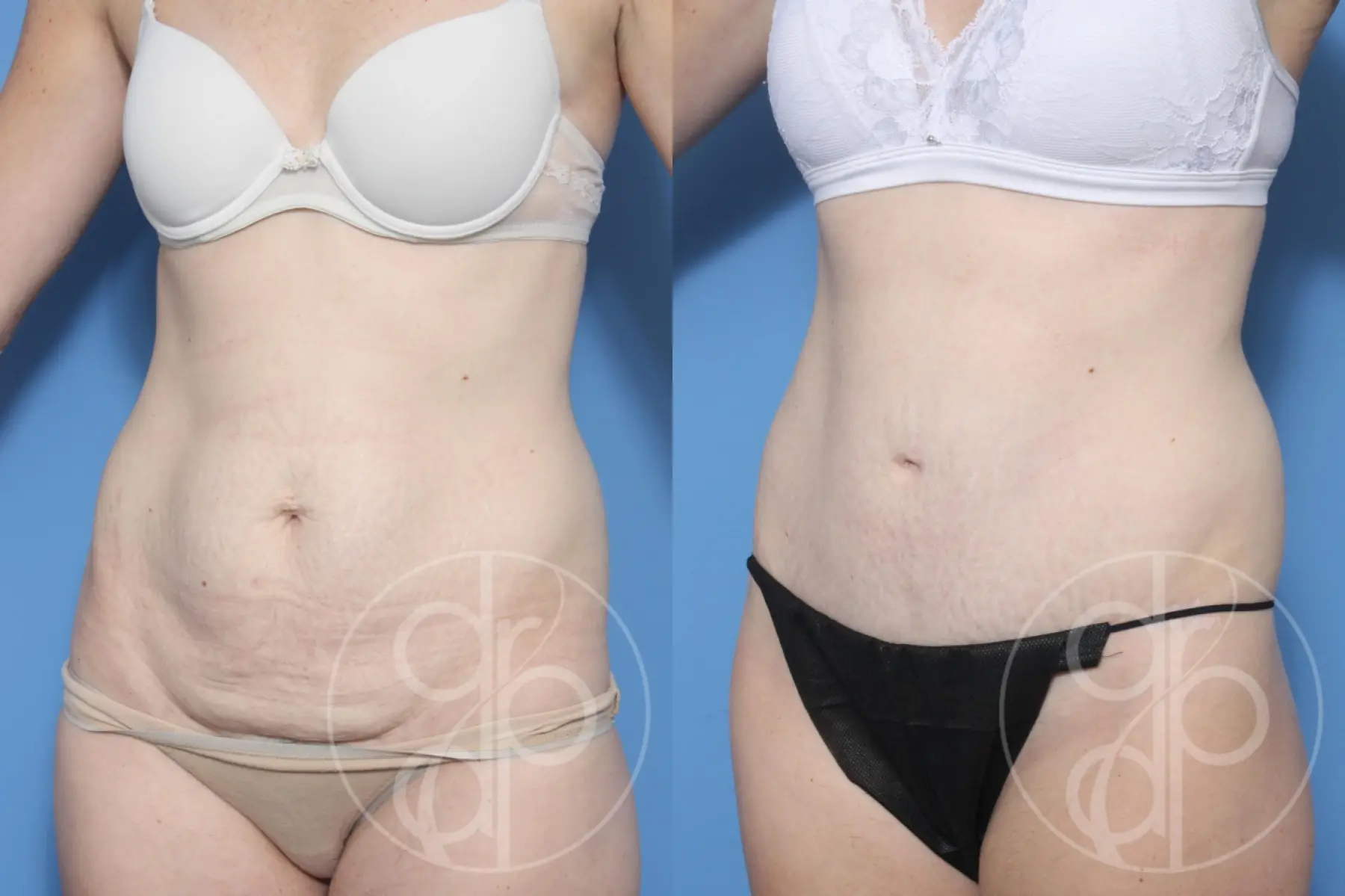 patient 12804 tummy tuck before and after result - Before and After 3