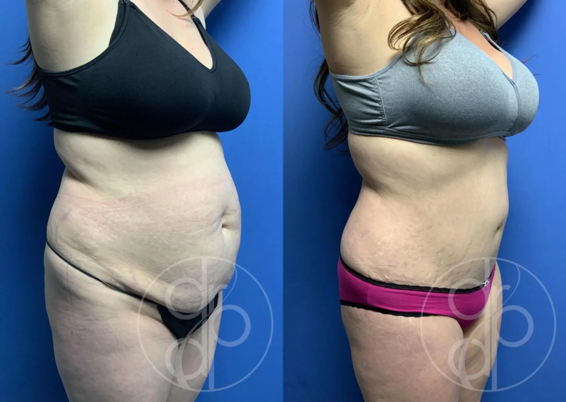 patient 12093 tummy tuck before and after result - Before and After 3