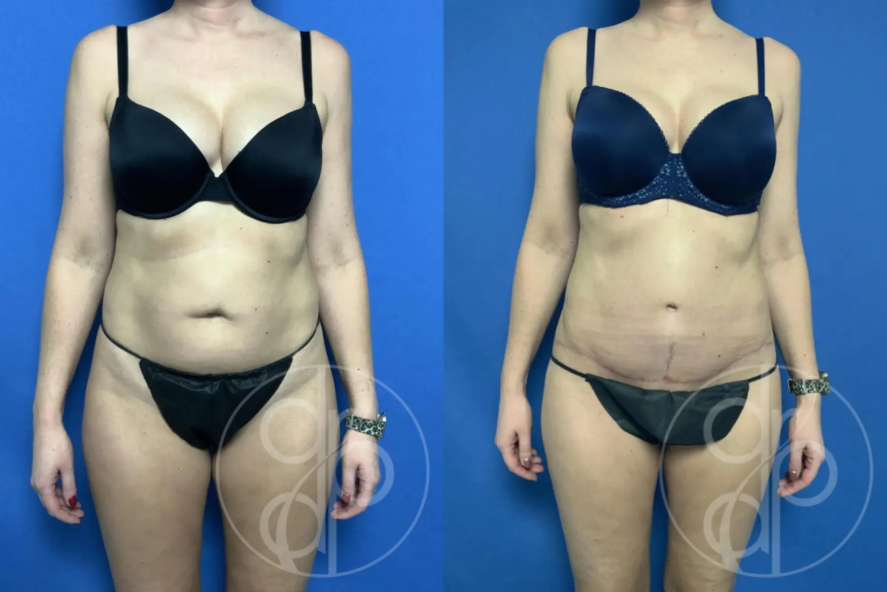 patient 12620 tummy tuck before and after result - Before and After 3