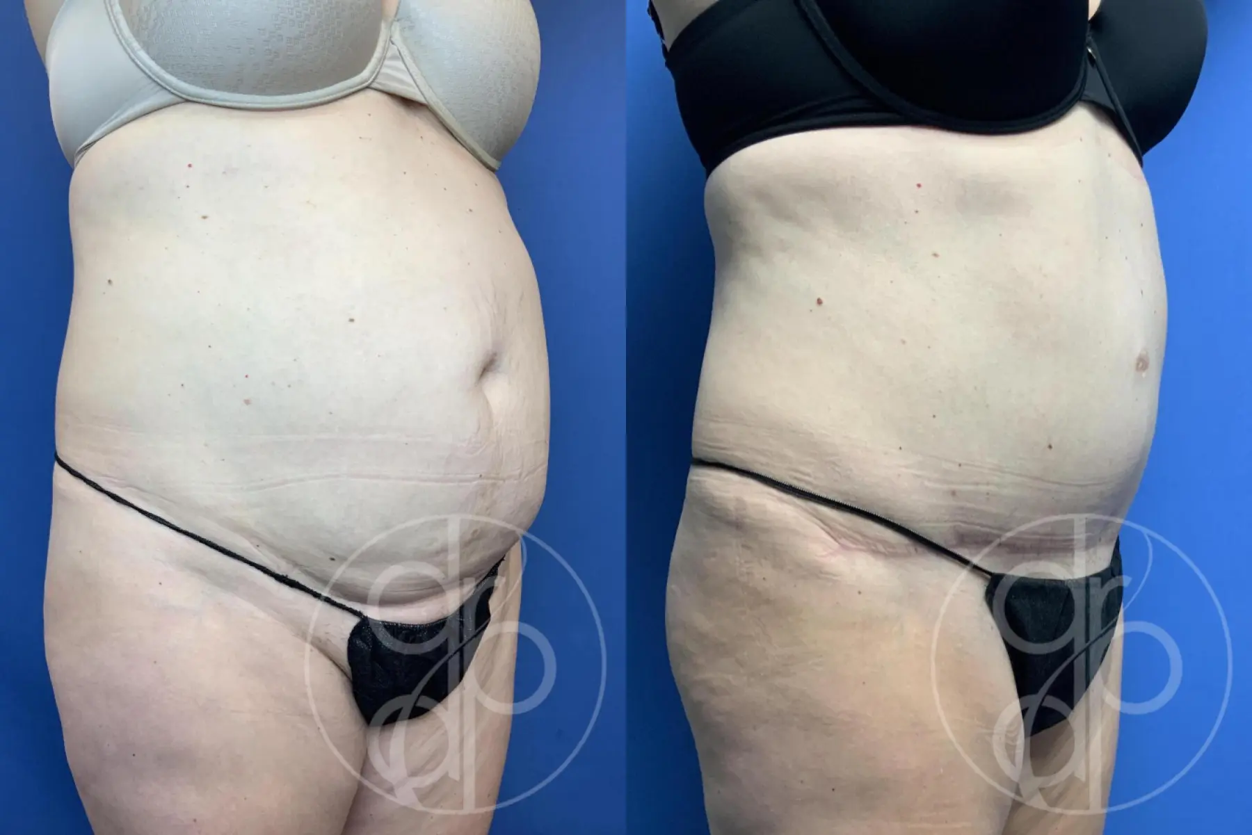 Abdominoplasty: Patient 40 - Before and After 2