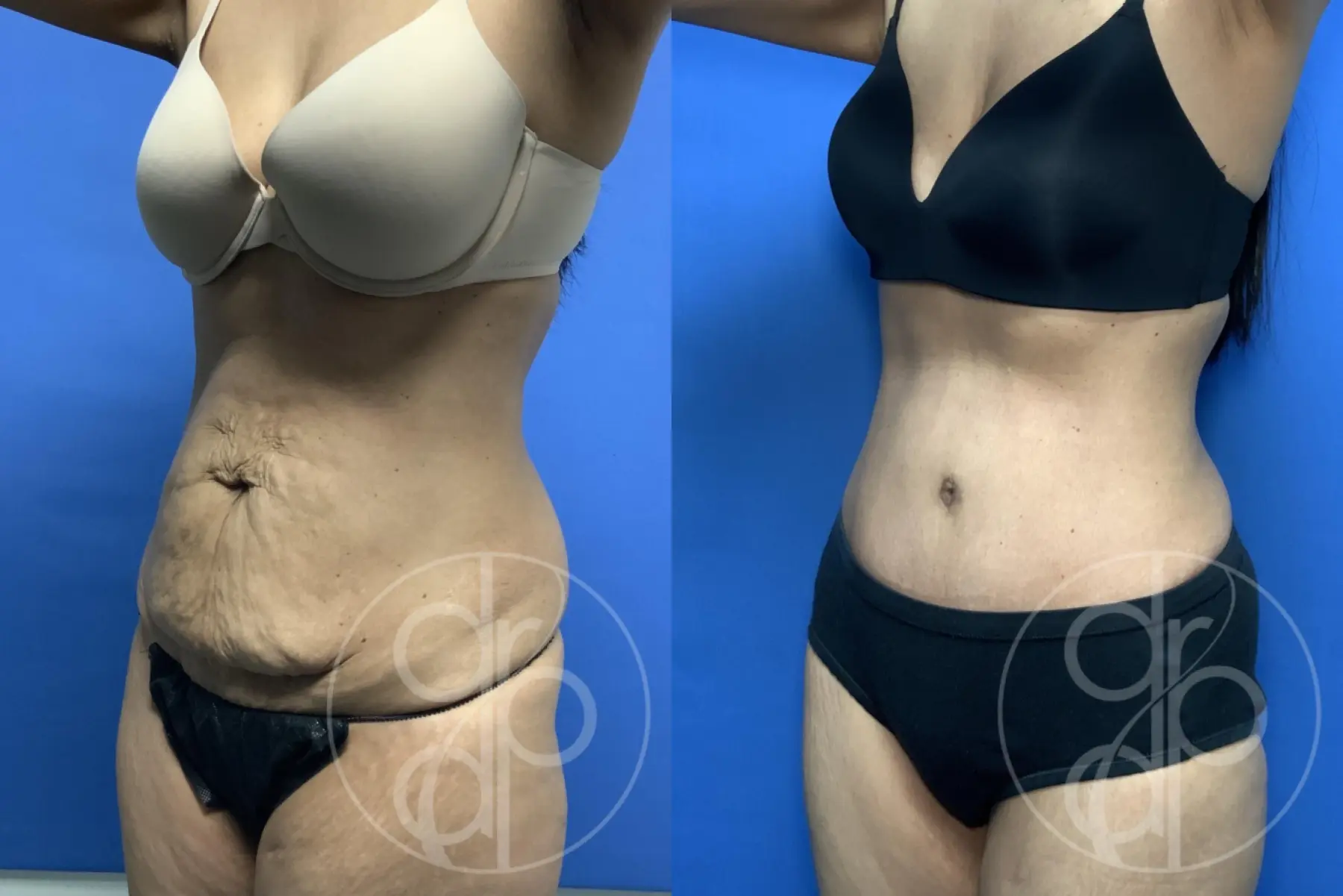 patient 13839 tummy tuck before and after result - Before and After 2