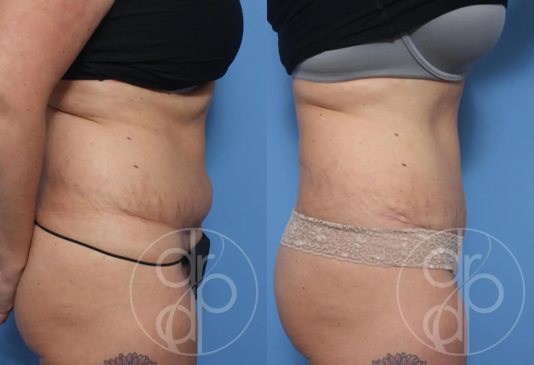 patient 13294 tummy tuck before and after result - Before and After 2