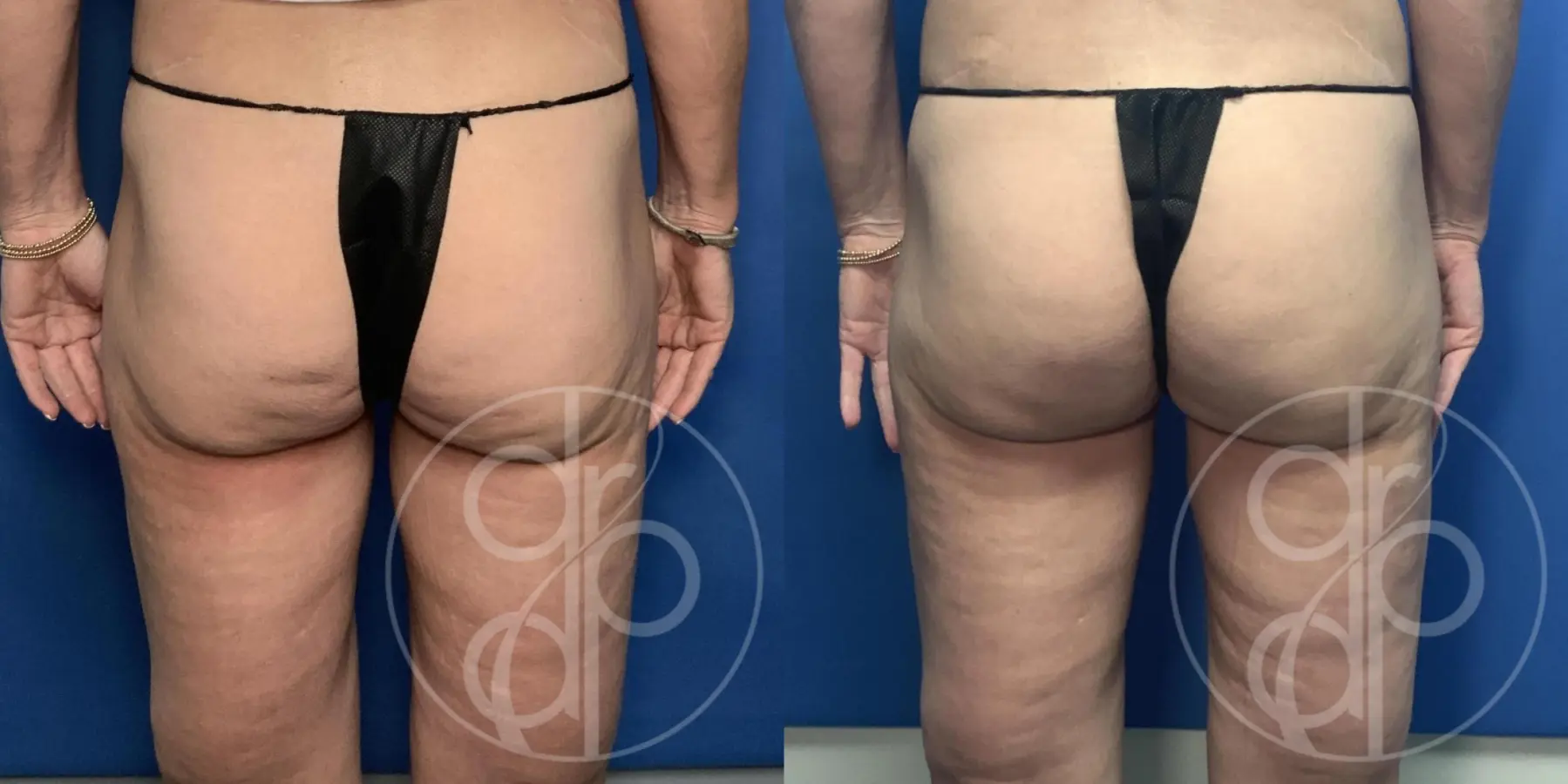Patient 14125 Avèli procedure before and after result - Before and After