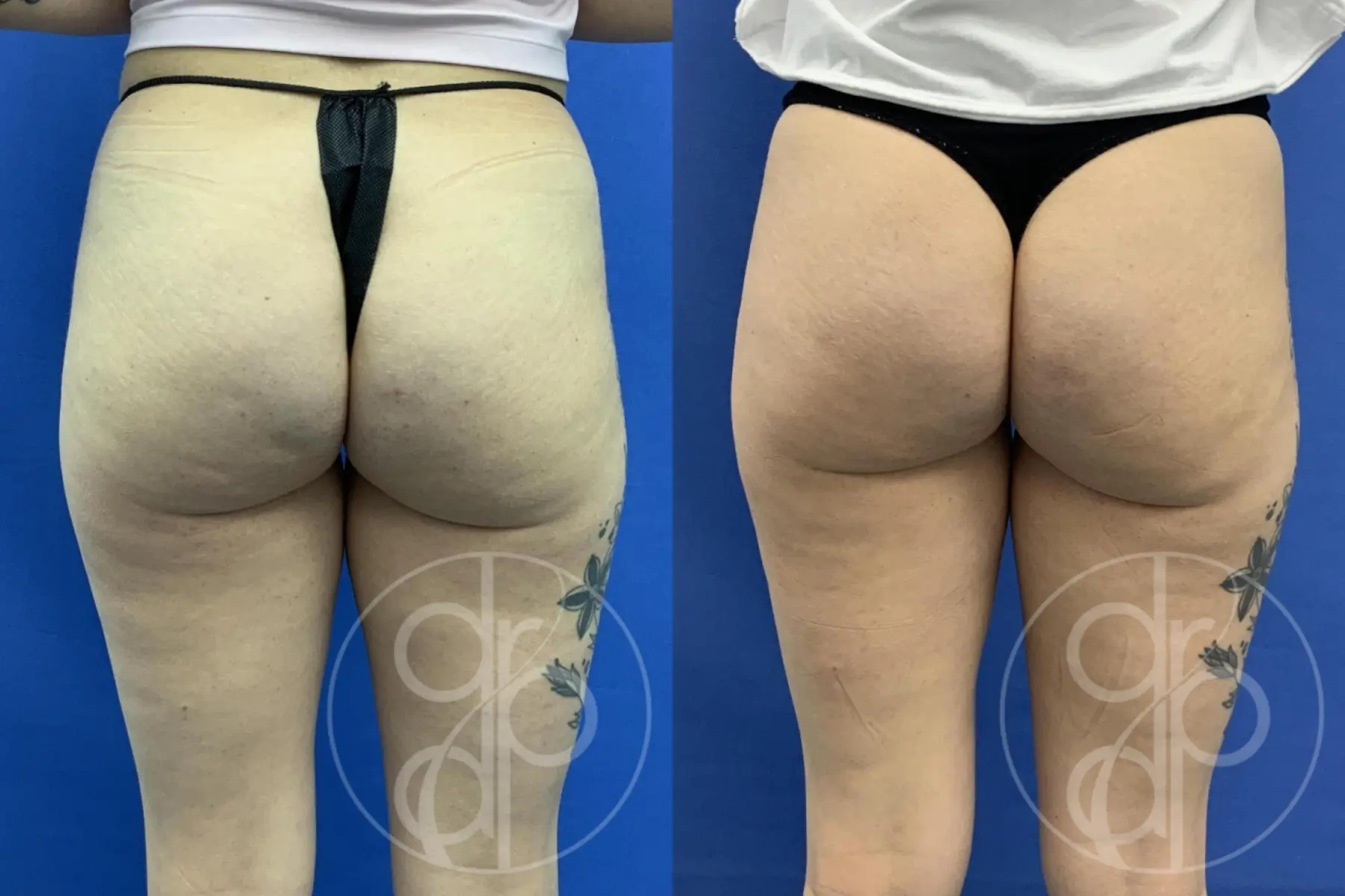Avèli: Patient 3 - Before and After  