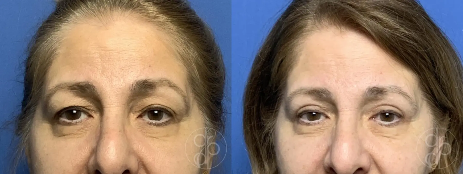patient 13764 blepharoplasty before and after result - Before and After 1