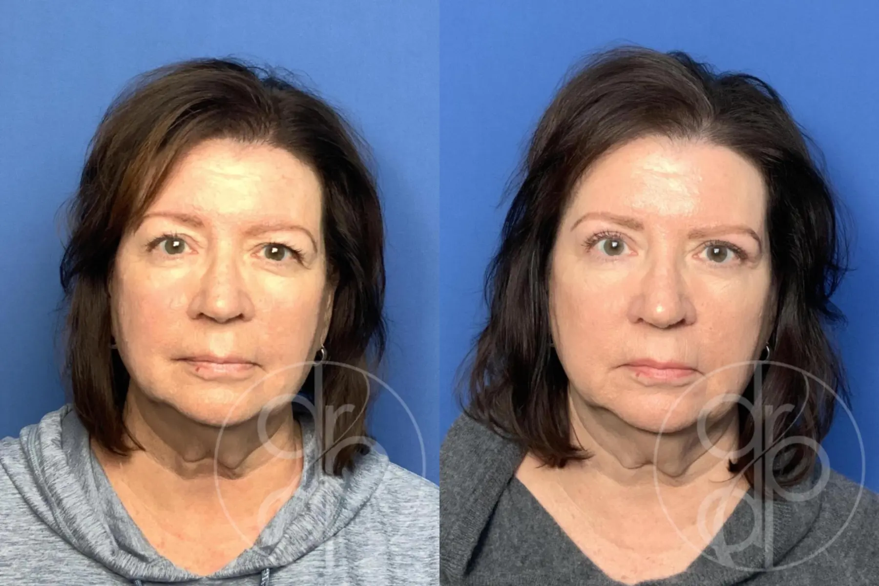 patient 14184 blepharoplasty before and after result - Before and After