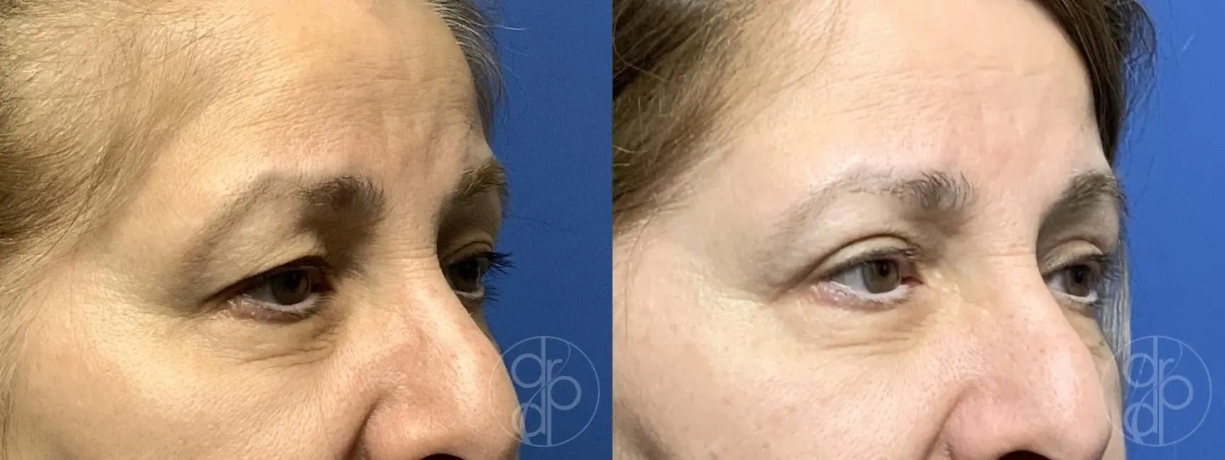 patient 13764 blepharoplasty before and after result - Before and After 2