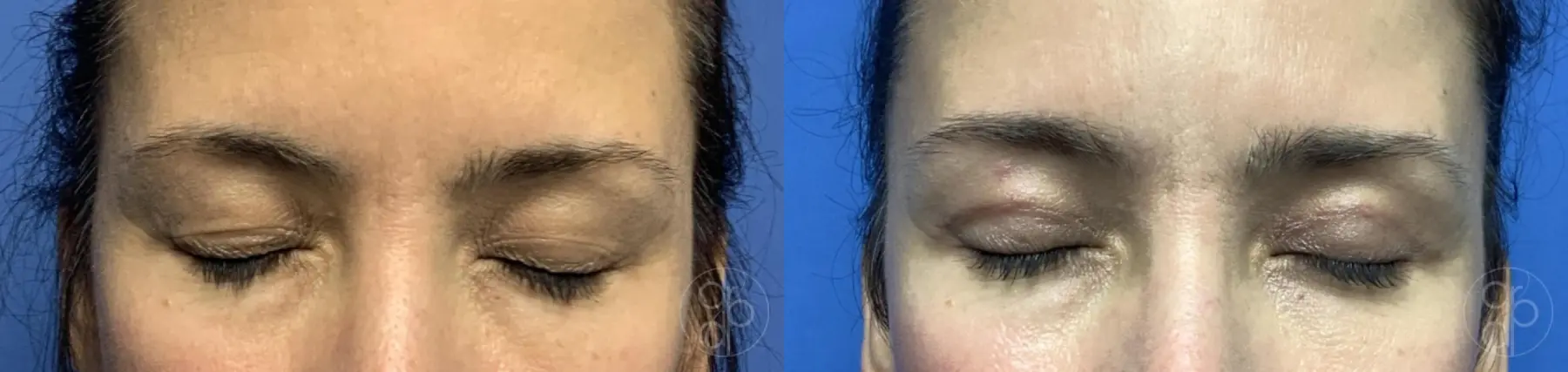 patient 12658 blepharoplasty before and after result - Before and After