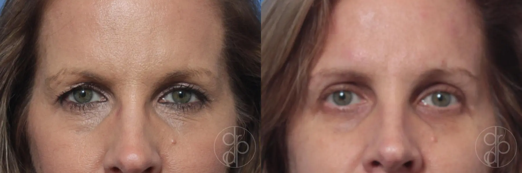patient 10511 blepharoplasty before and after result - Before and After 1