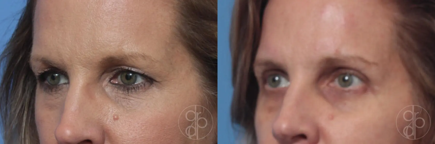 patient 10511 blepharoplasty before and after result - Before and After 2