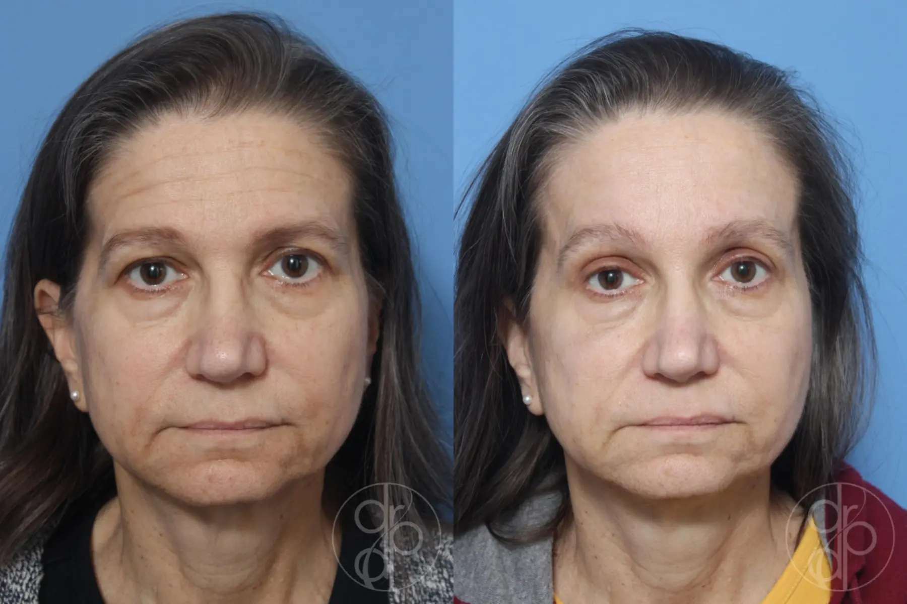 patient 12880 blepharoplasty before and after result - Before and After 1