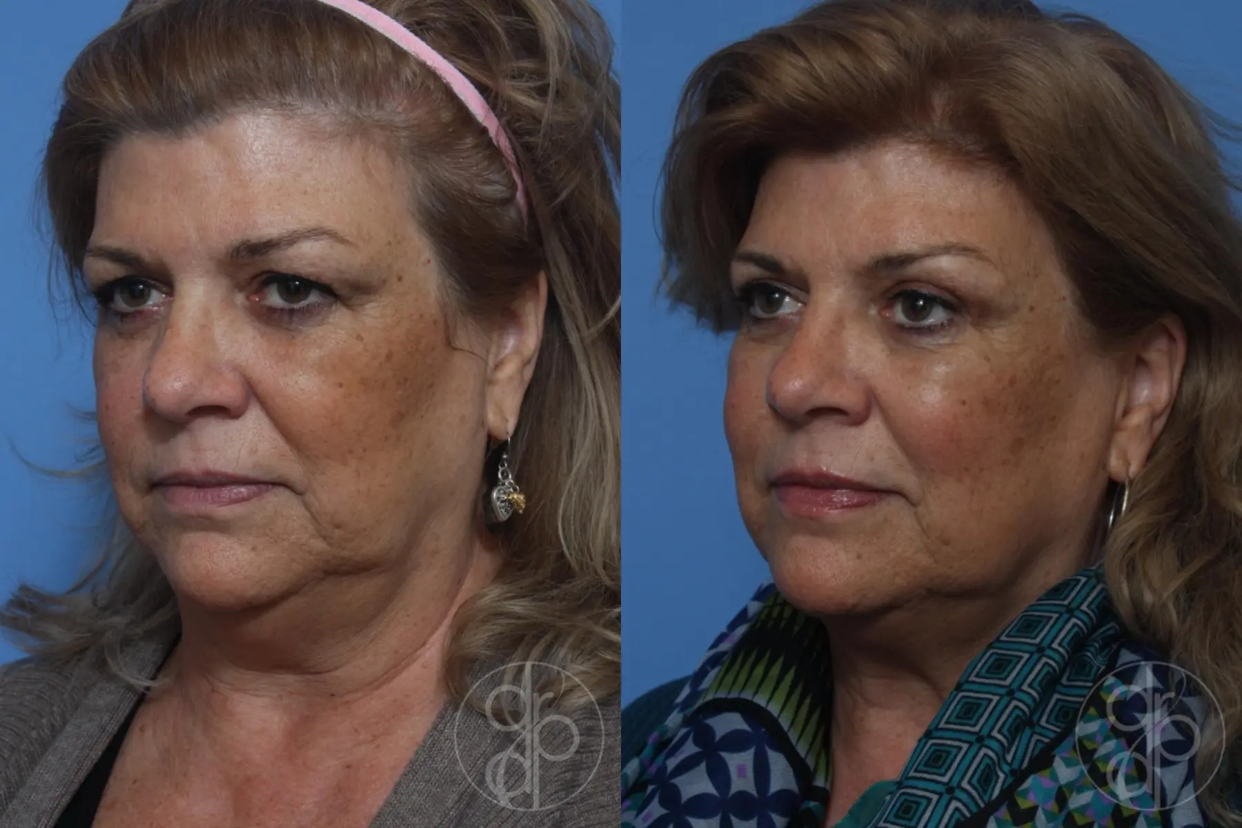 patient 10525 blepharoplasty before and after result - Before and After 3