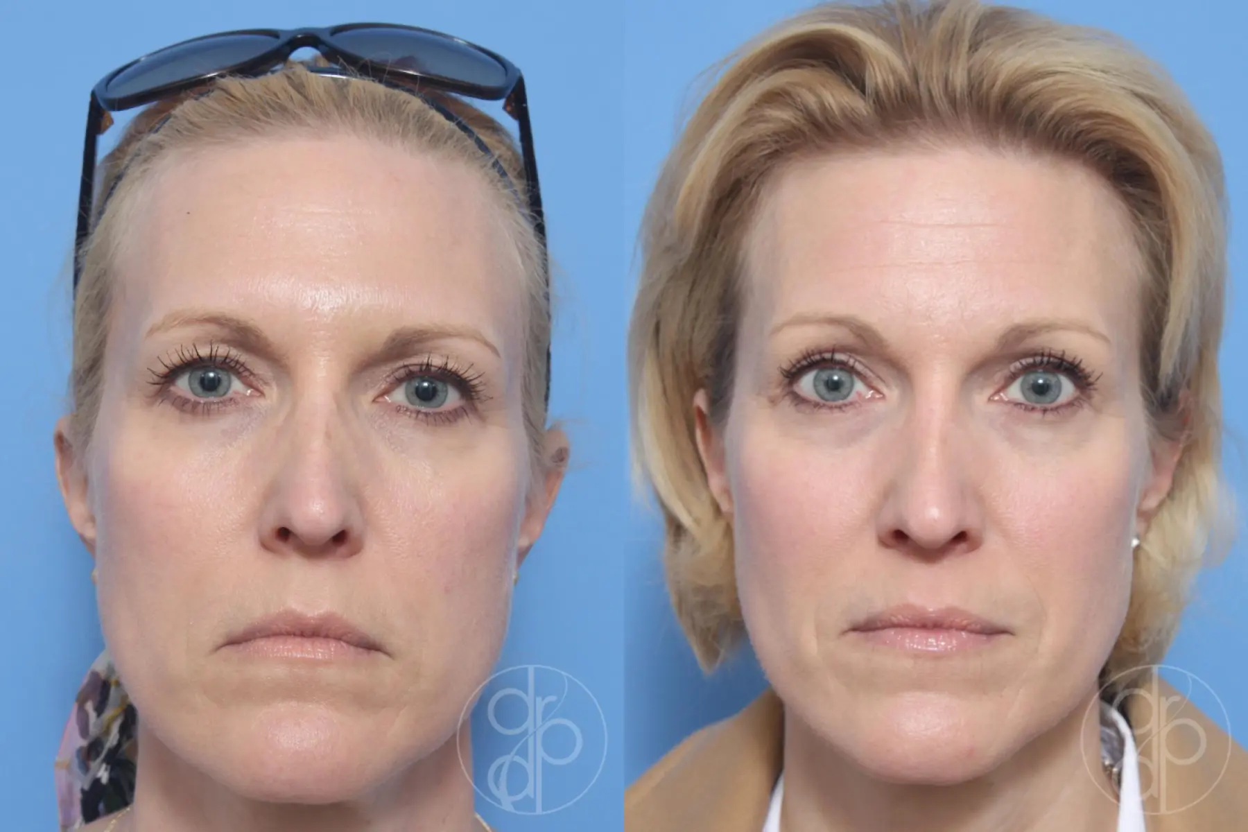 patient 13240 blepharoplasty before and after result - Before and After 1