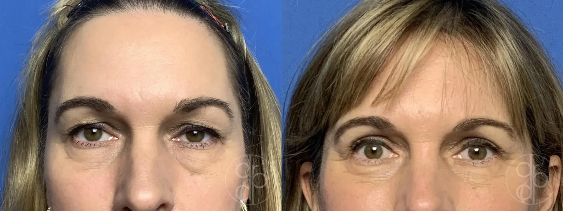 patient 13381 blepharoplasty before and after result - Before and After 1