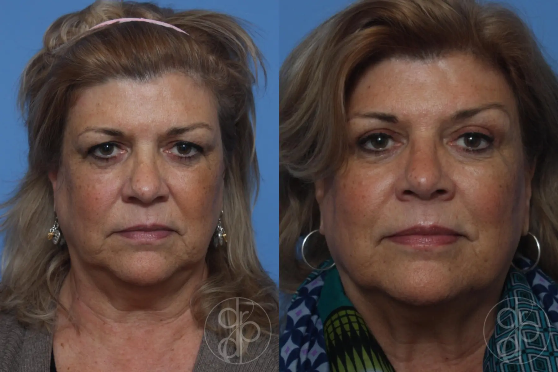 patient 10525 blepharoplasty before and after result - Before and After 1