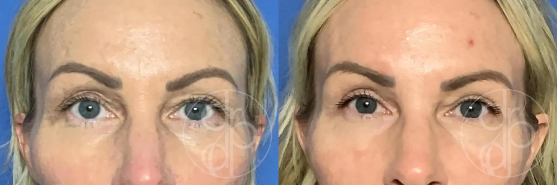Patient 12733 Blepharoplasty procedure before and after result - Before and After