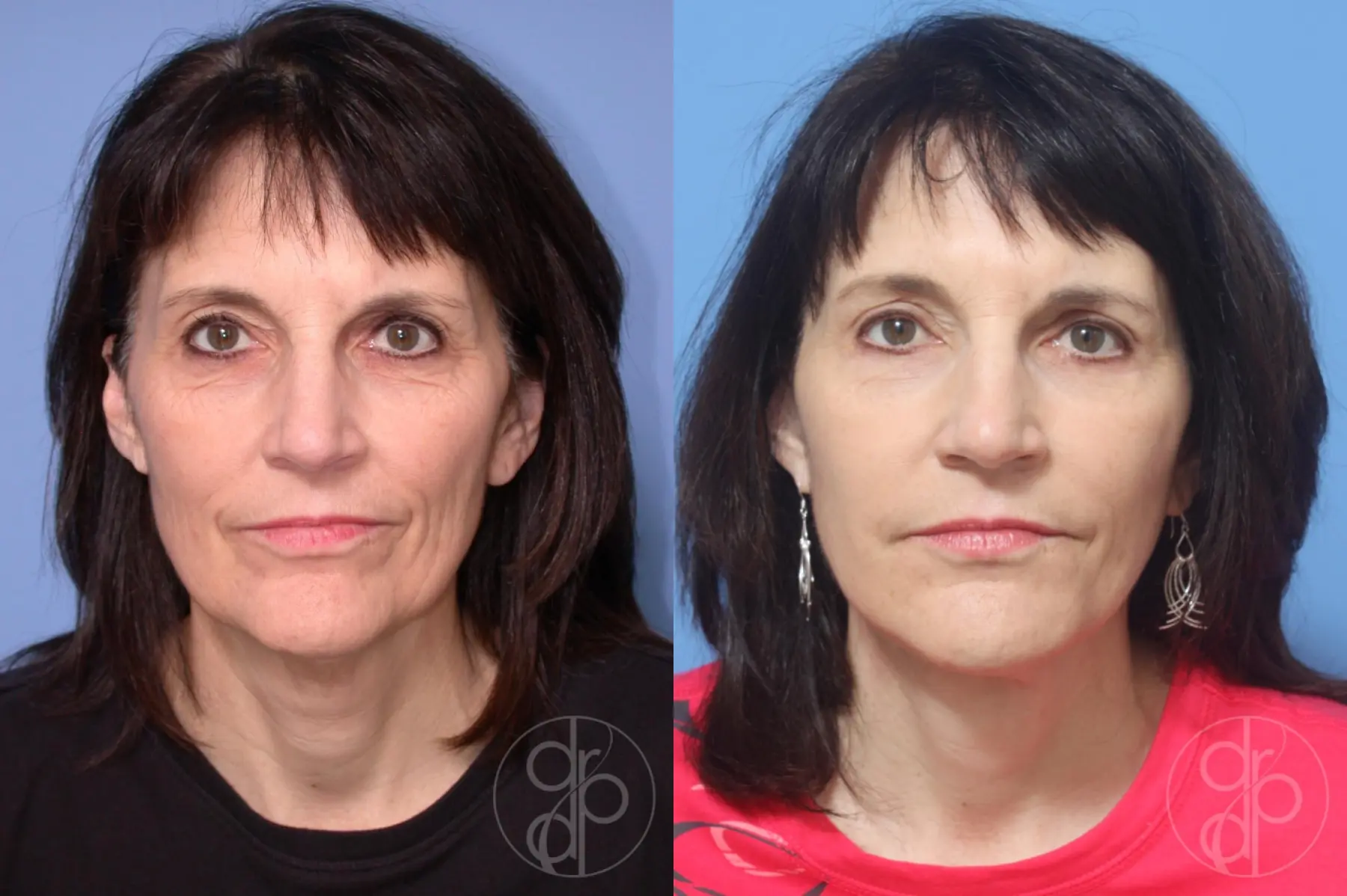 patient 12915 blepharoplasty before and after result - Before and After