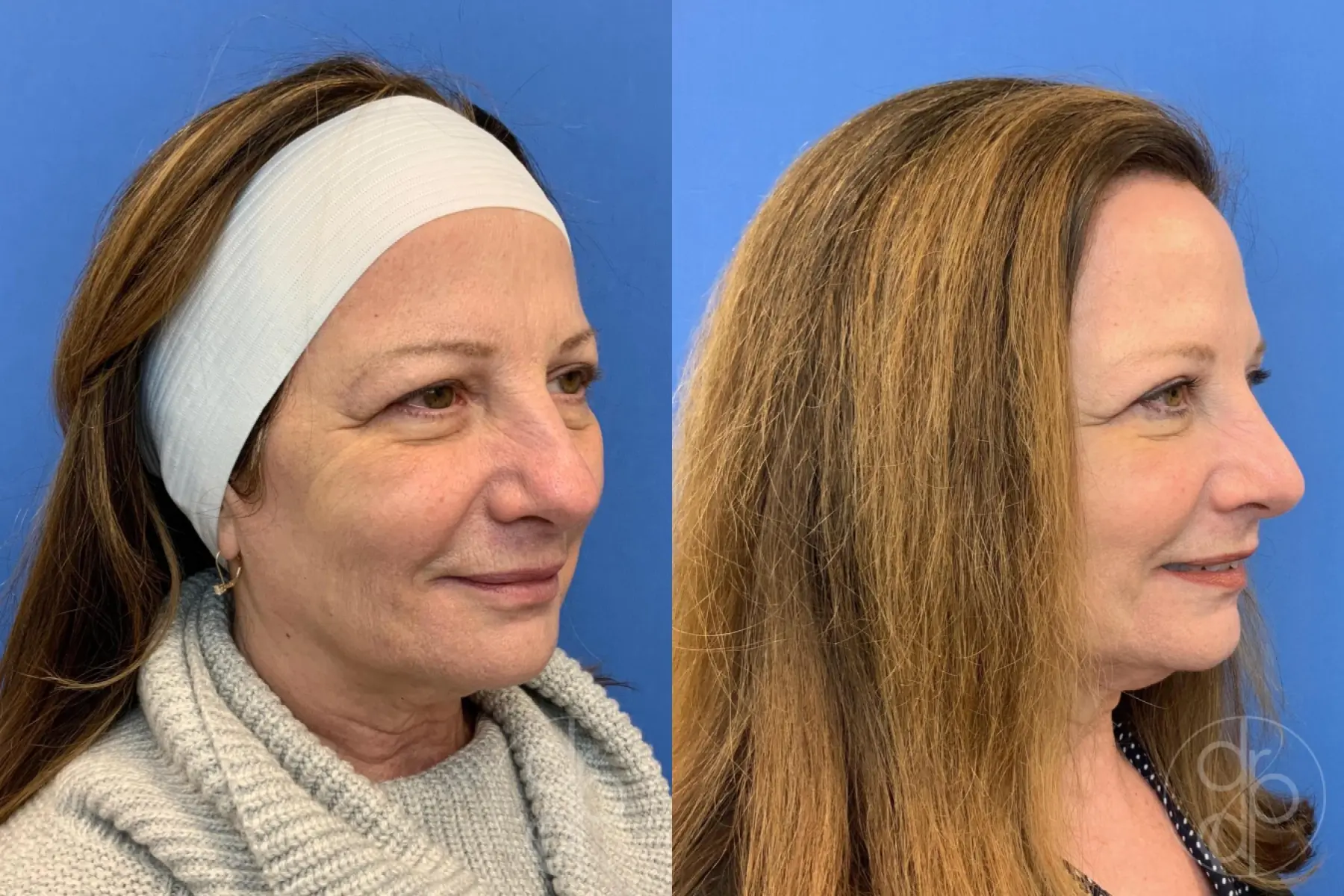 patient 10645 blepharoplasty before and after result - Before and After 2