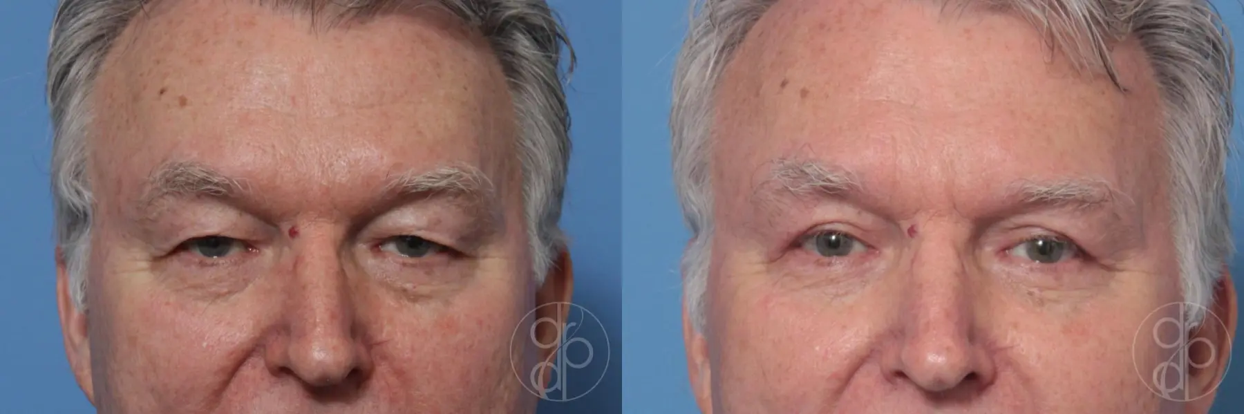 patient 10268 blepharoplasty before and after result - Before and After 1