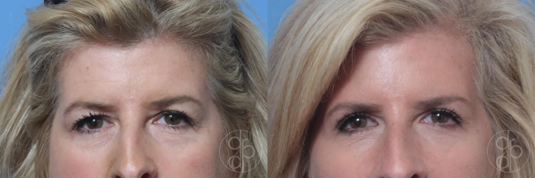 patient 10616 blepharoplasty before and after result - Before and After