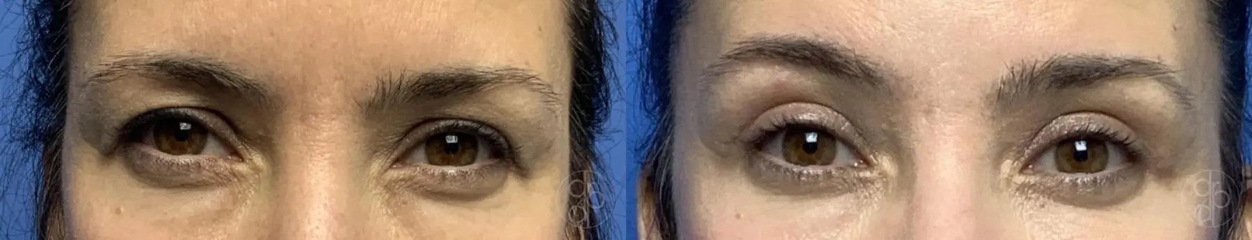 patient 12658 blepharoplasty before and after result - Before and After 2