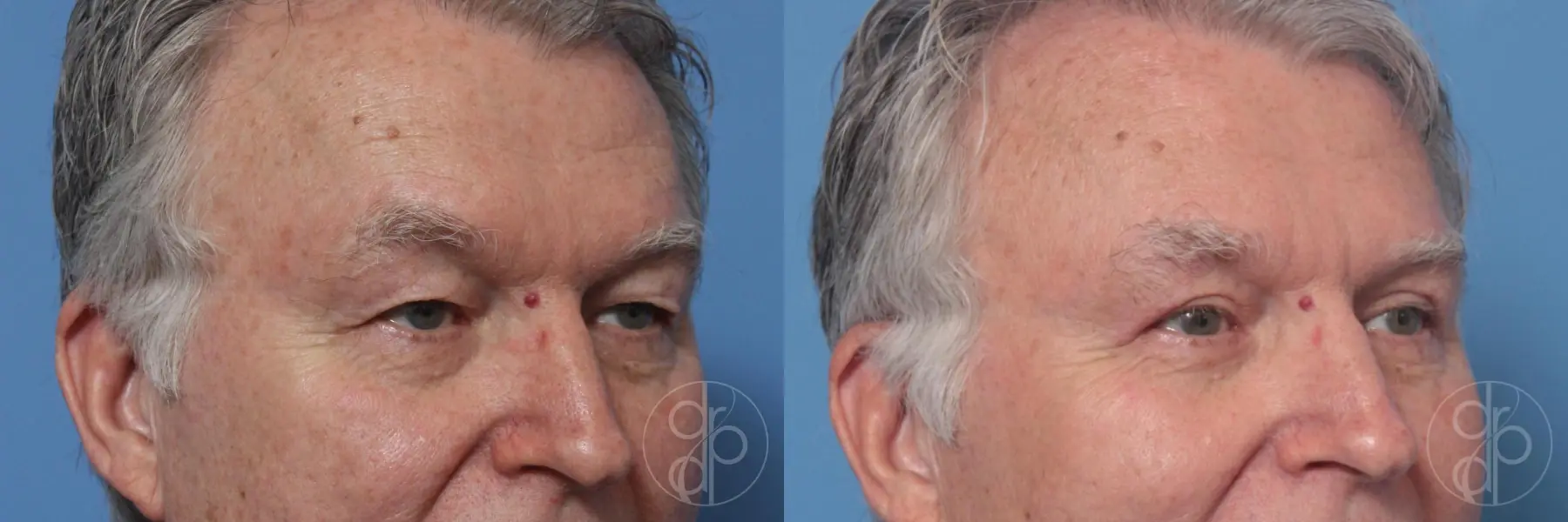 patient 10268 blepharoplasty before and after result - Before and After 2