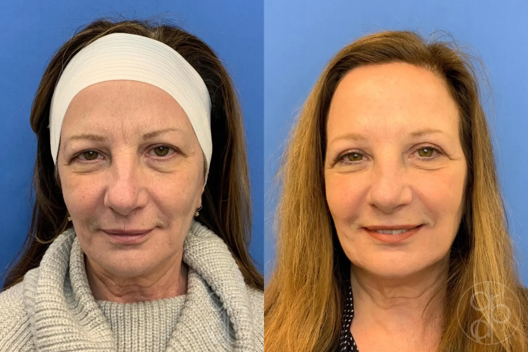 patient 10645 blepharoplasty before and after result - Before and After 1