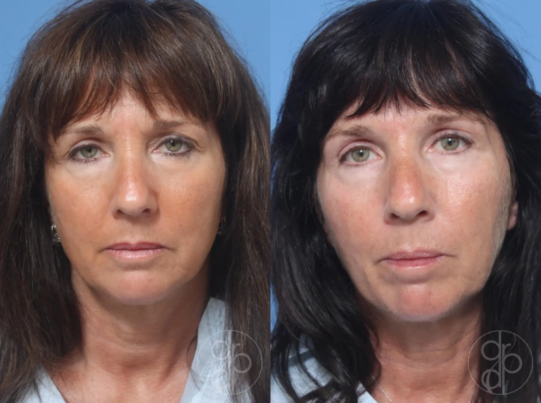 Blepharoplasty: Patient 8 - Before and After  