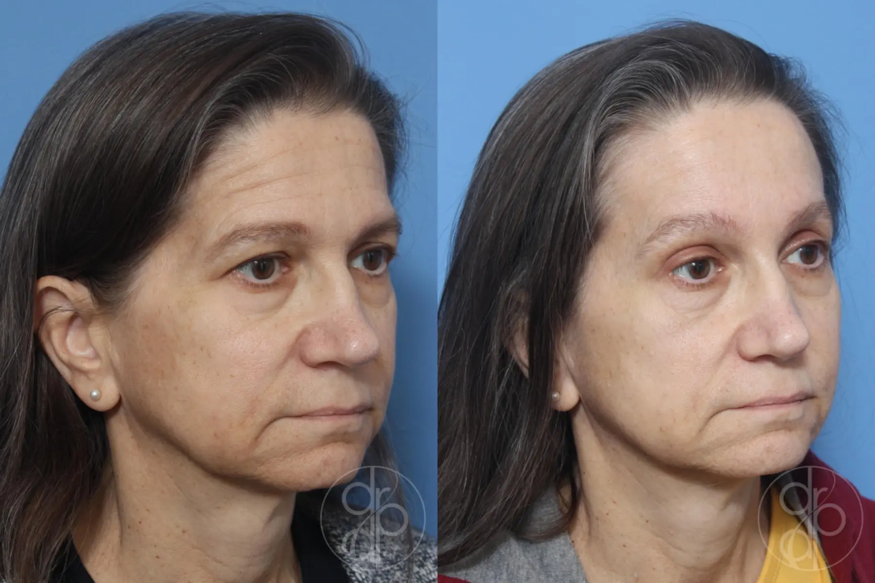 patient 12880 blepharoplasty before and after result - Before and After 2