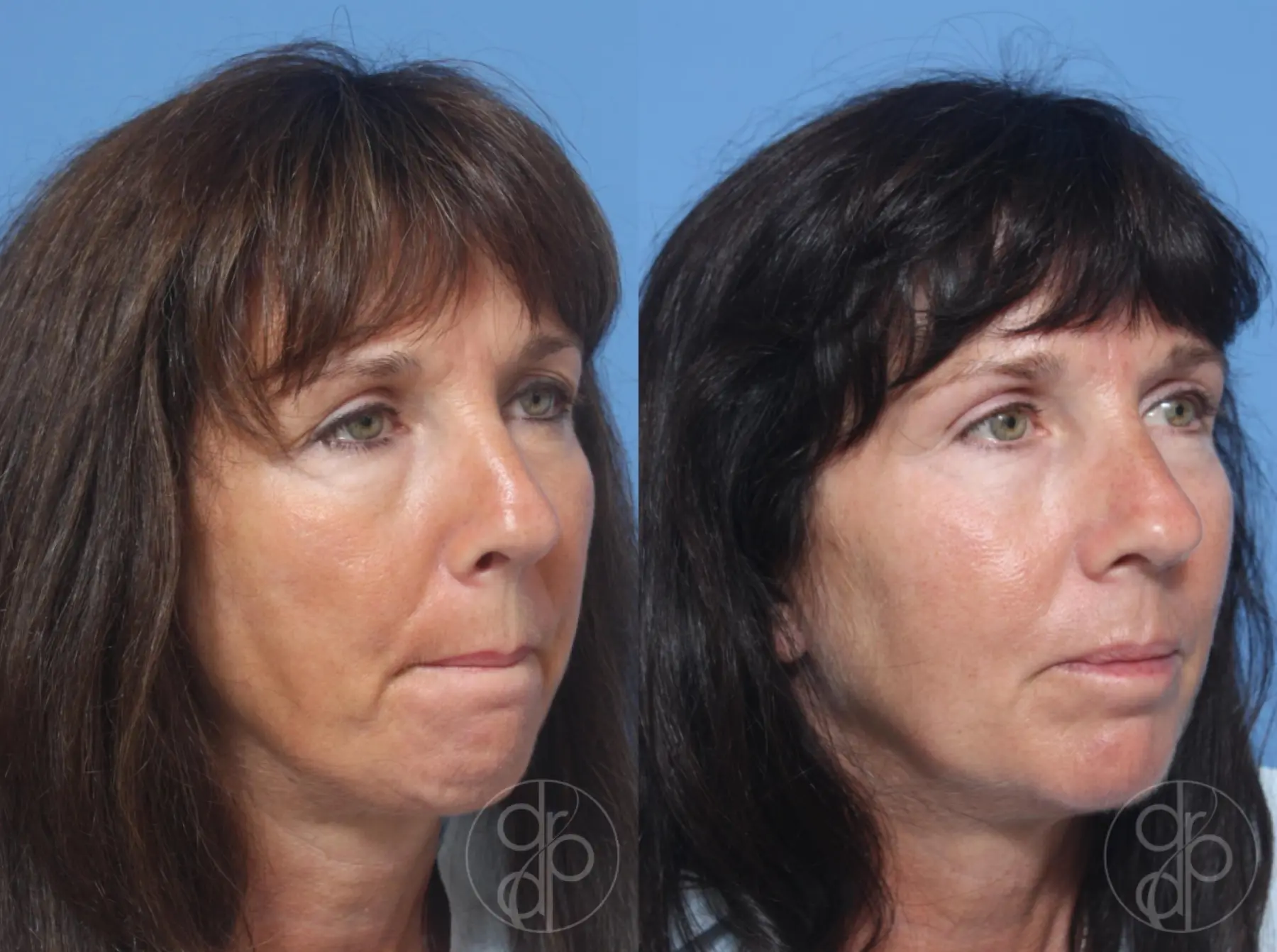 patient 11904 blepharoplasty before and after result - Before and After 2
