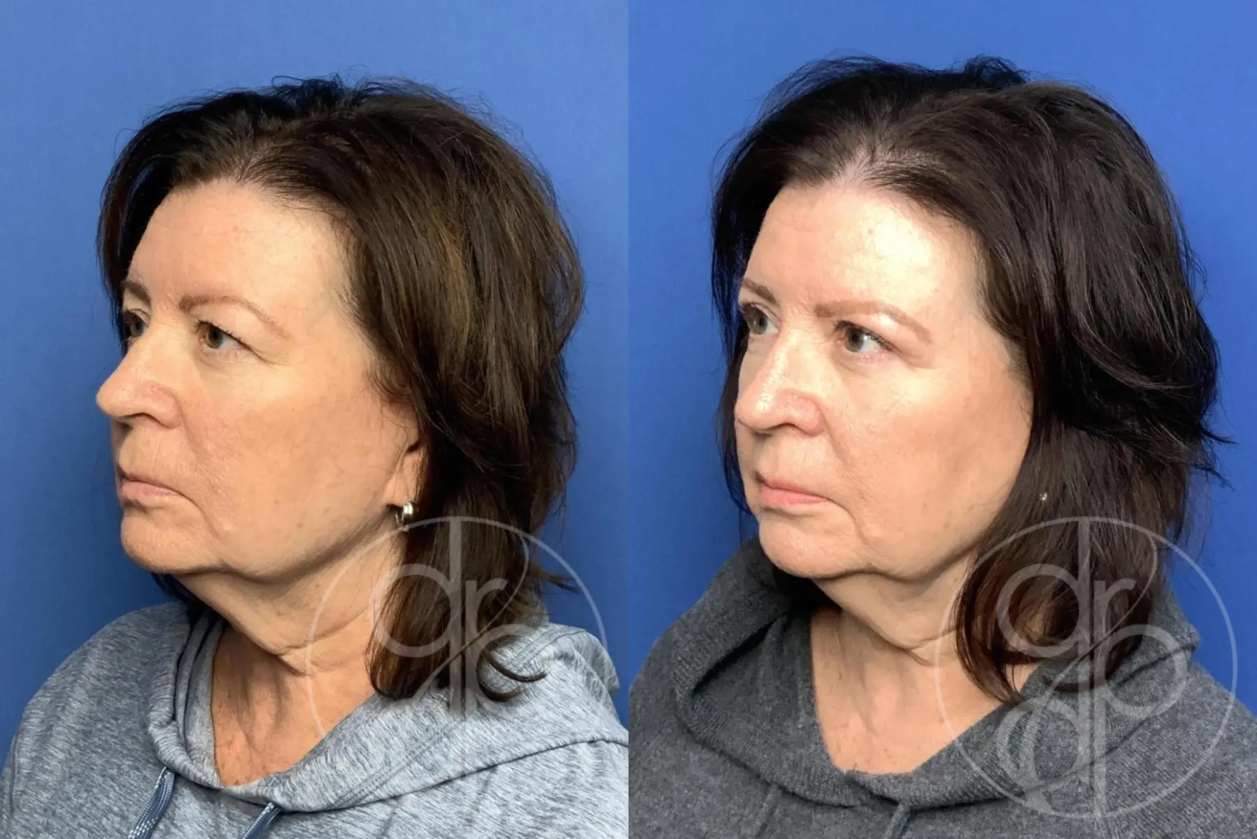 Blepharoplasty: Patient 14 - Before and After 3
