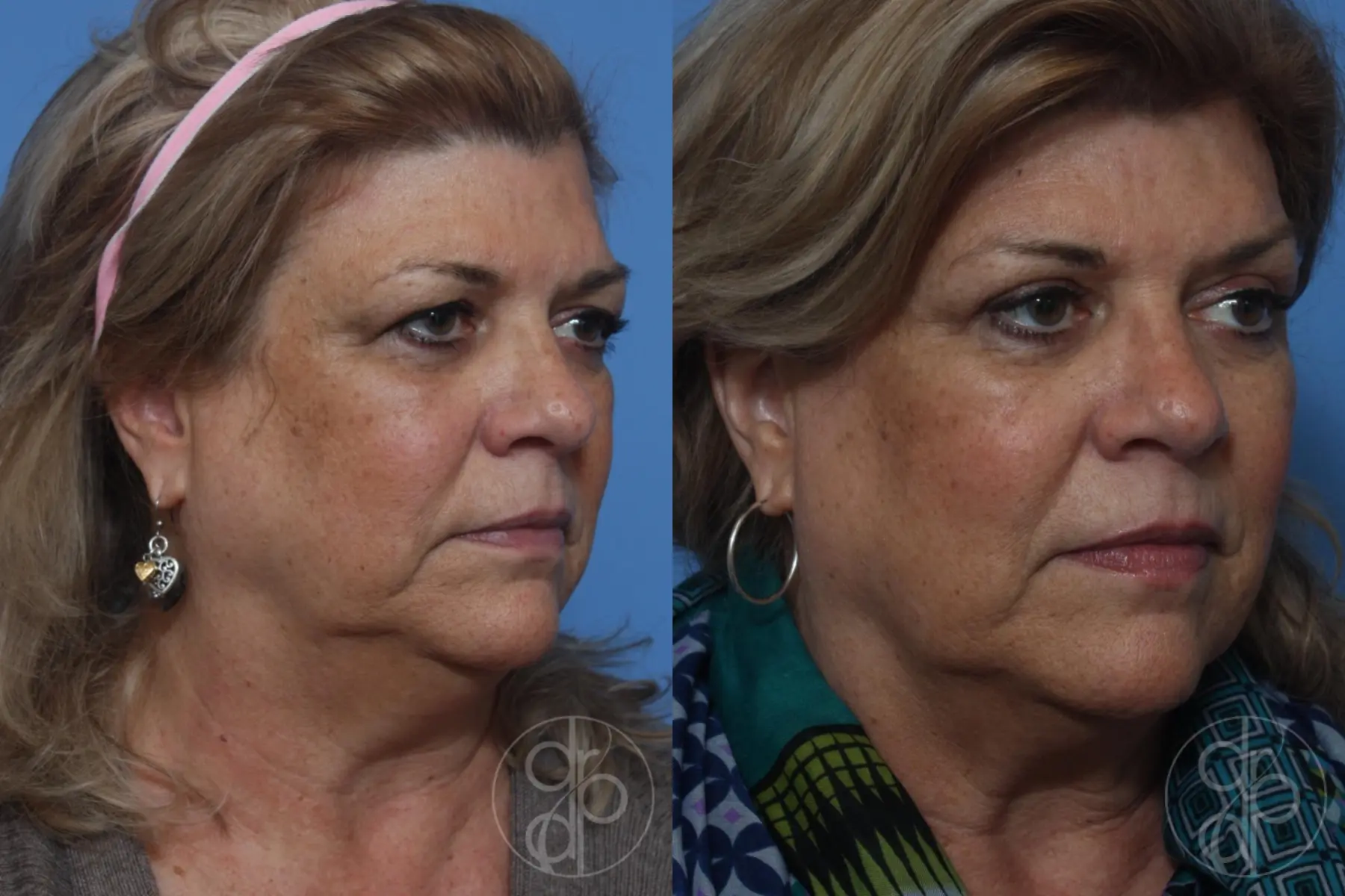 patient 10525 blepharoplasty before and after result - Before and After 2