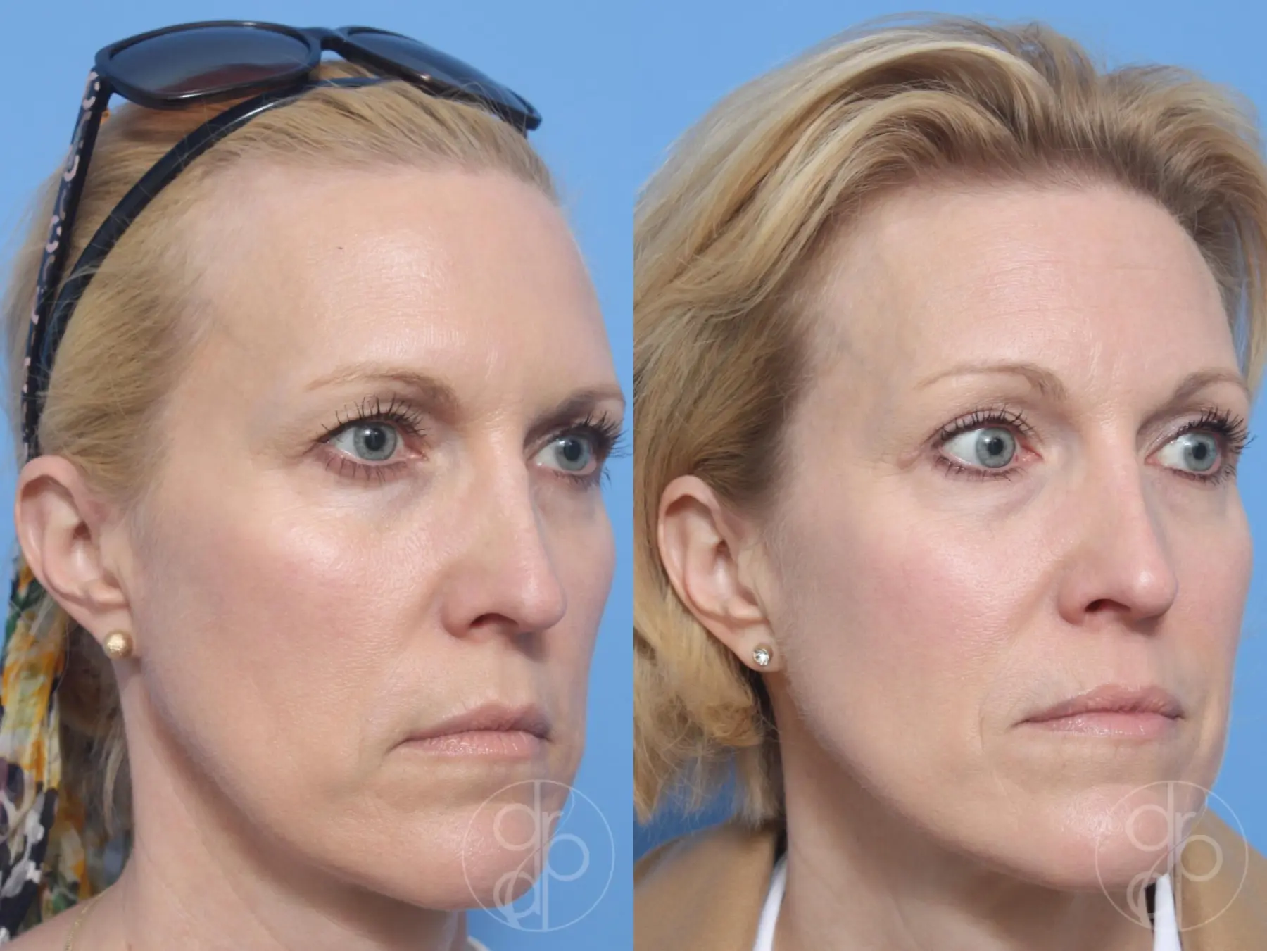 patient 13240 blepharoplasty before and after result - Before and After 2
