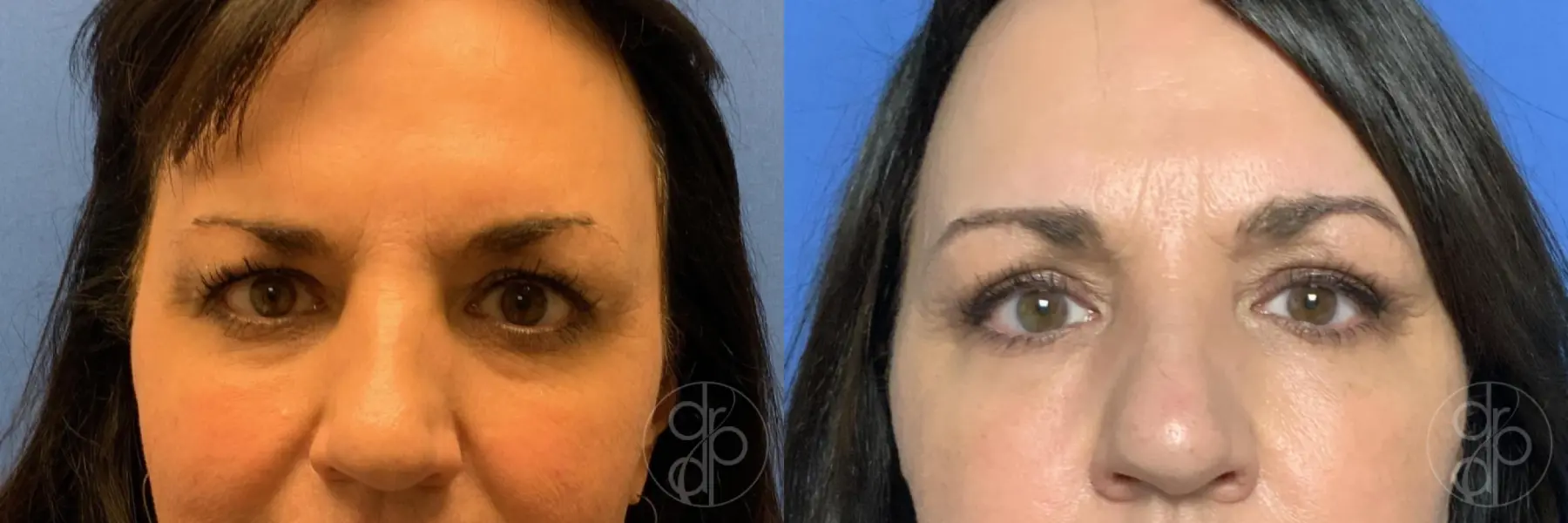 patient 10706 blepharoplasty before and after result - Before and After 1