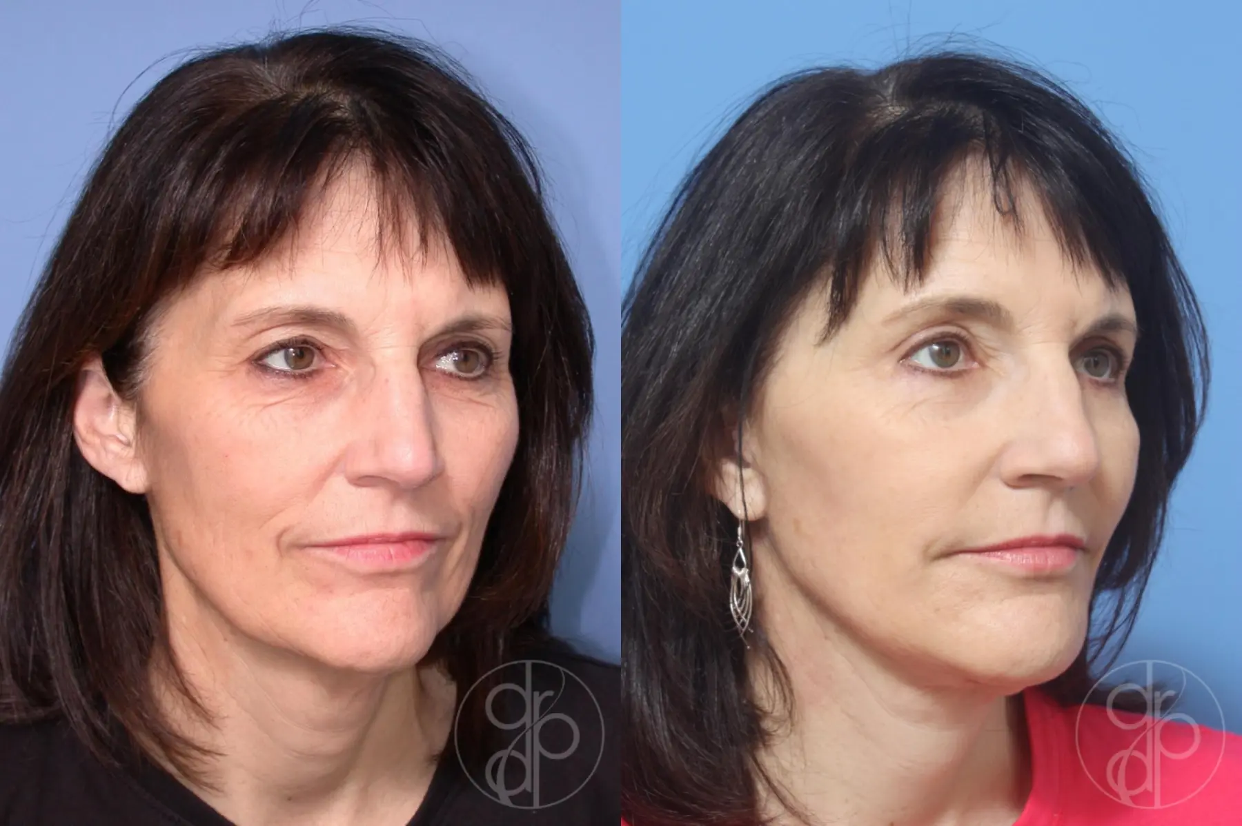 patient 12915 blepharoplasty before and after result - Before and After 2